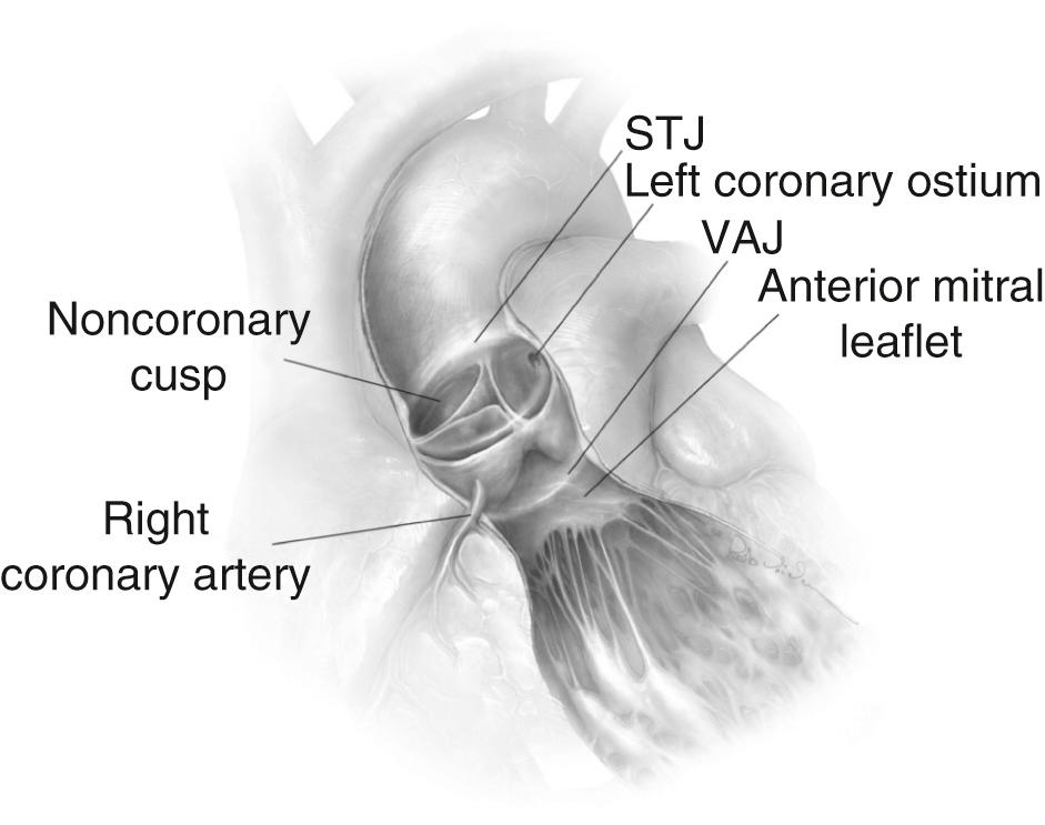 FIGURE 78-1, Anatomy of the aortic valve and the functional aortic annulus. STJ, Sinotubular junction; VAJ, ventriculo-aortic junction.