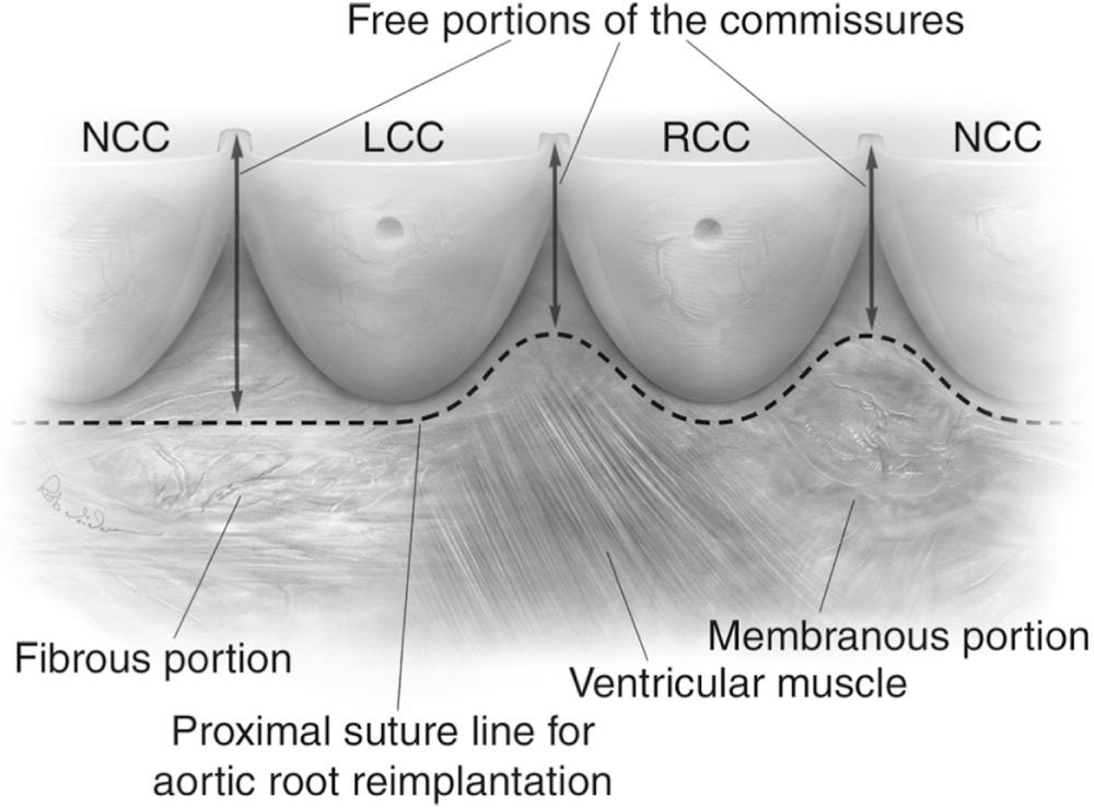 FIGURE 78-2, Anatomy of the subvalvular region of the aortic valve. The dotted line marks the limits of external dissection of the aortic root and the proximal suture line for a valve-sparing root replacement procedure using the reimplantation technique. LCC, Left coronary cusp; NCC, noncoronary cusp; RCC, right coronary cusp.
