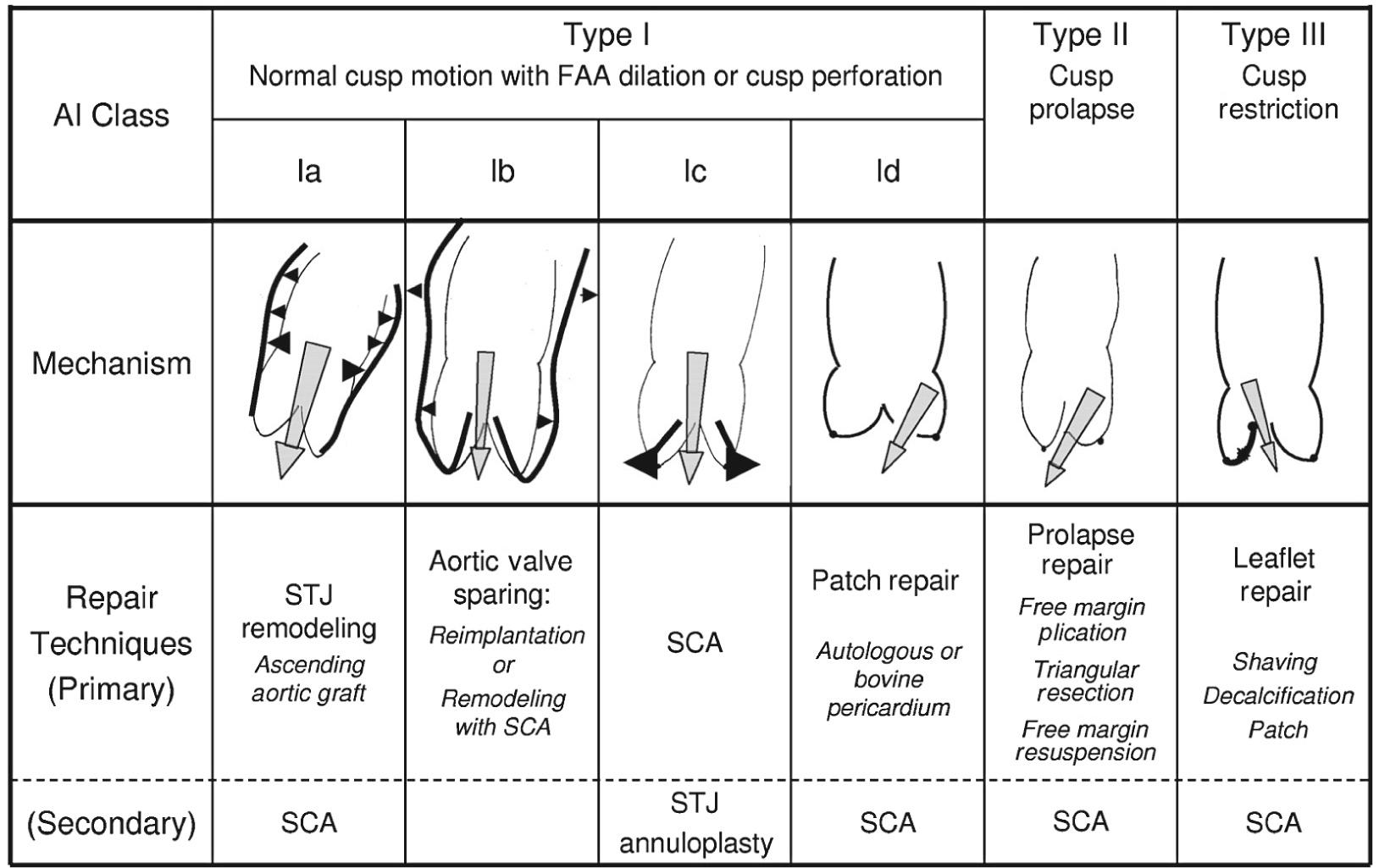 FIGURE 78-3, Repair-oriented classification of aortic insufficiency. FAA, Functional aortic annulus; SCA, subcommissural annuloplasty; STJ, sinotubular junction.