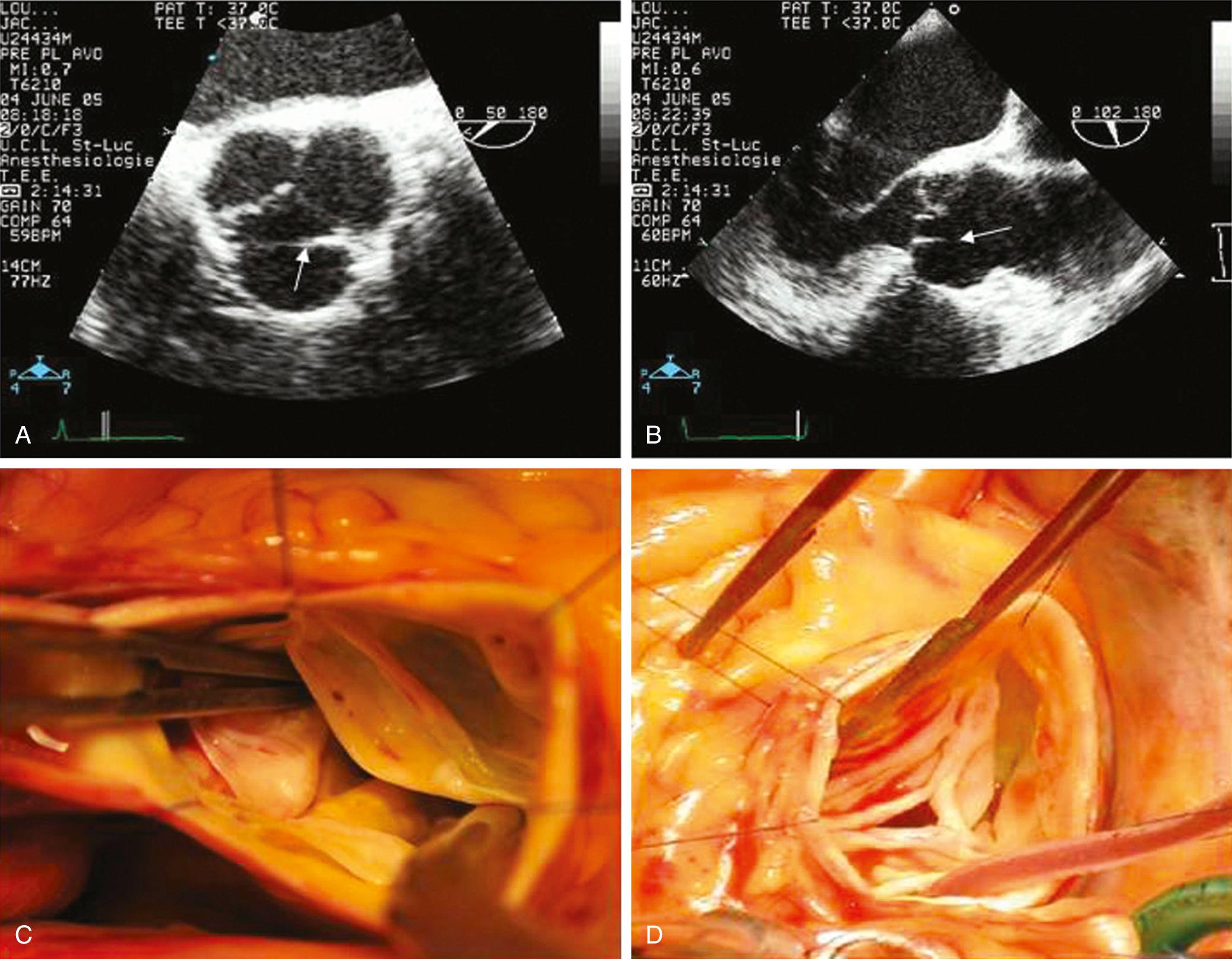 FIGURE 78-4, A and B, A transverse fibrous band is typically visible on echocardiography (arrow) and surgical inspection (C, D) in the setting cusp prolapse in trileaflet aortic valves and may help in the detection and localization of cusp prolapse.