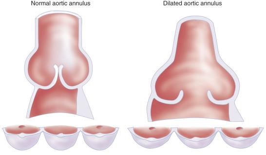 Figure 13.5, Dilation of the aortic annulus flattens the subcommissural triangles of the noncoronary cusp and pulls the belly of the cusps apart.