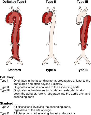 Fig. 44.1, Common classifications of thoracic aortic dissection.