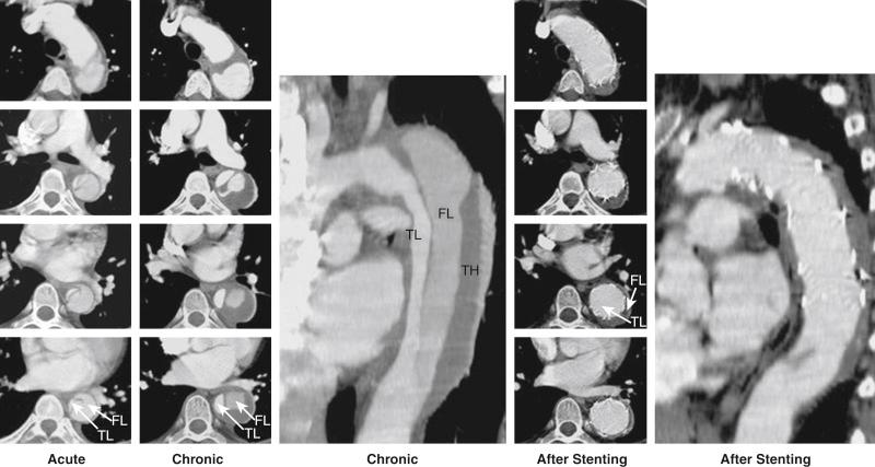 Fig. 44.2, Type B aortic dissection in a 48-year-old man.