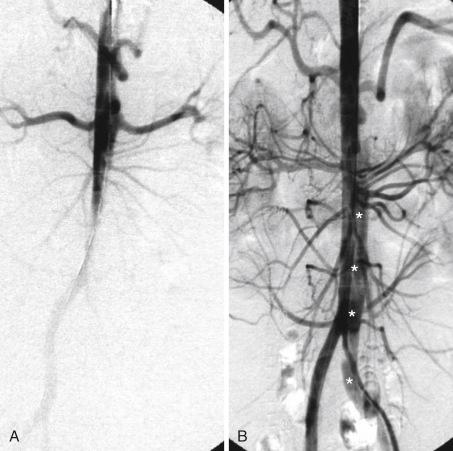 Fig. 44.3, Digital subtraction angiography of a thoracoabdominal type B dissection.