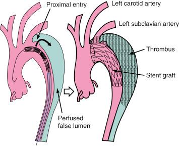 Fig. 44.4, Interventional reconstruction of the dissected aorta with sealing of the proximal entries, depressurization of the false lumen, and initiation of the false lumen thrombosis.