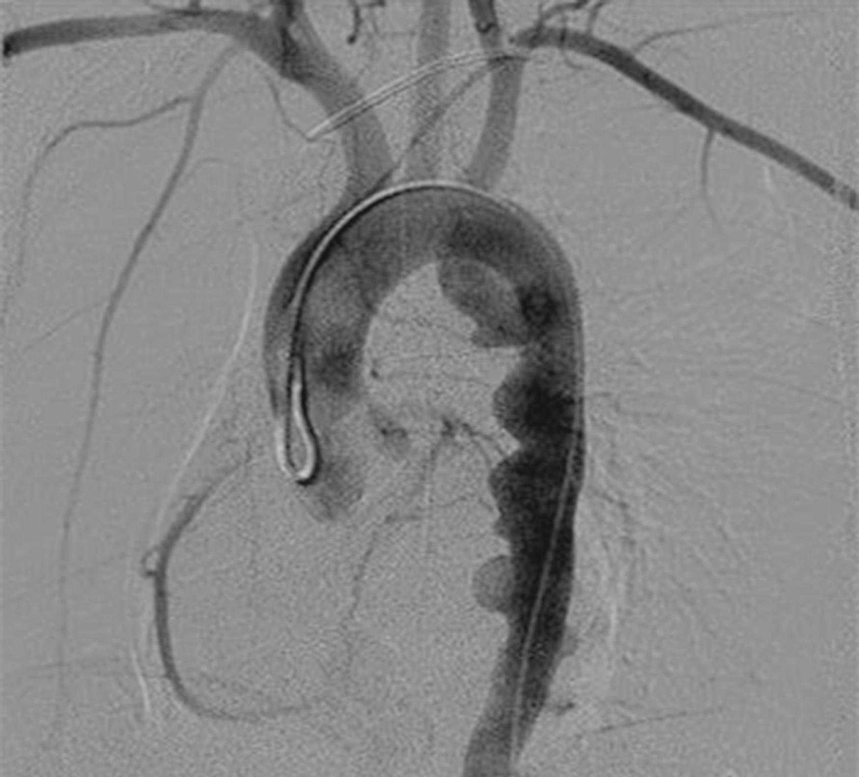 Figure 186.1, Multiple saccular aortic aneurysms along the anteromedial aspect of the descending thoracic aorta in a 5-year-old with tuberous sclerosis.