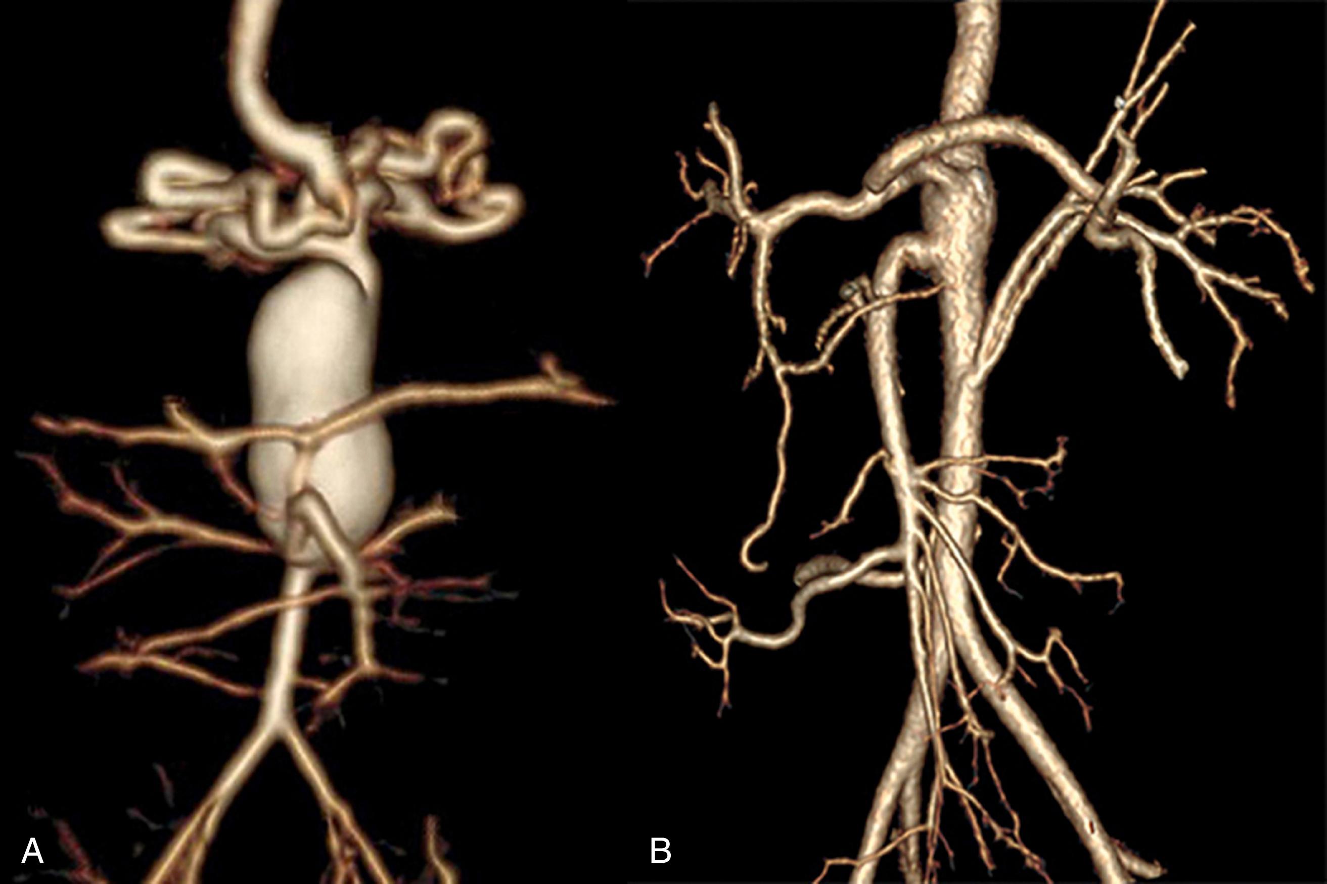 Figure 186.2, ( A ) Saccular supraceliac abdominal aortic aneurysm with involvement of the celiac, superior mesenteric, and renal arteries associated with focal and nearly complete occlusion (coarctation) of the diaphragmatic aorta in a 6-month-old (computed tomography angiography). ( B ) Appearance following resection of the coarcted aortic segment with primary aorto-aortic reanastomosis, open aneurysmorrhaphy, and aortic reimplantation of one of the affected arteries with no evidence of progressive aortic dilation 7 years postoperatively.