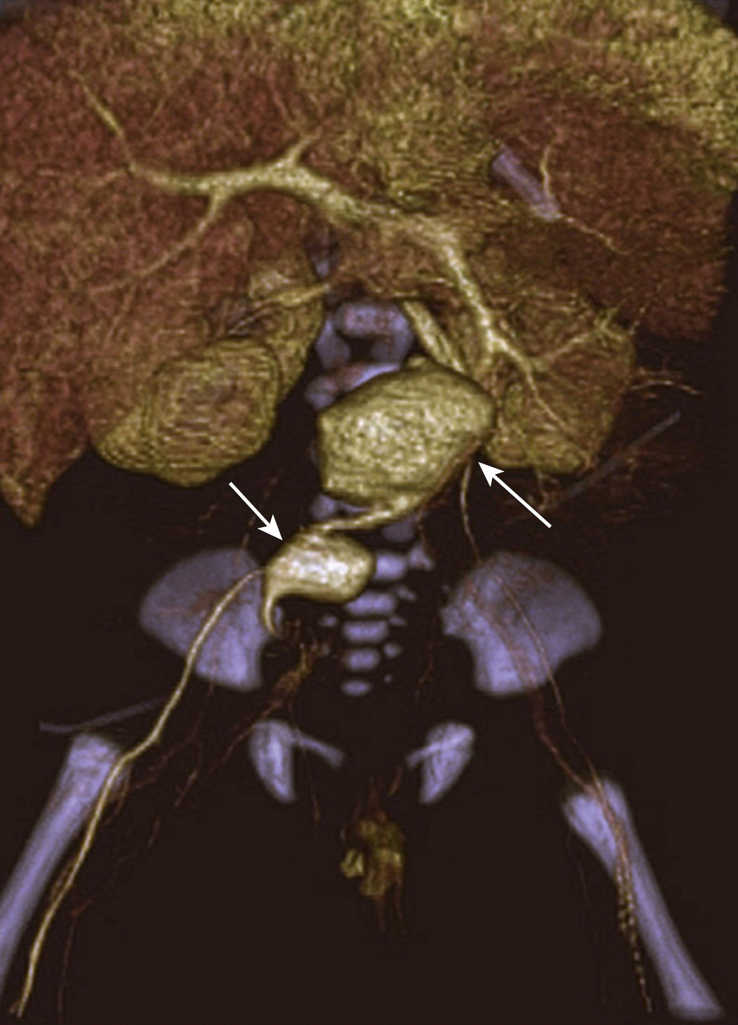Figure 186.3, Infectious infrarenal abdominal aortic aneurysm (right arrow) and a right iliac artery aneurysm (left arrow) in a 2-week-old associated with infected umbilical catheterization and sepsis (computed tomography angiography).