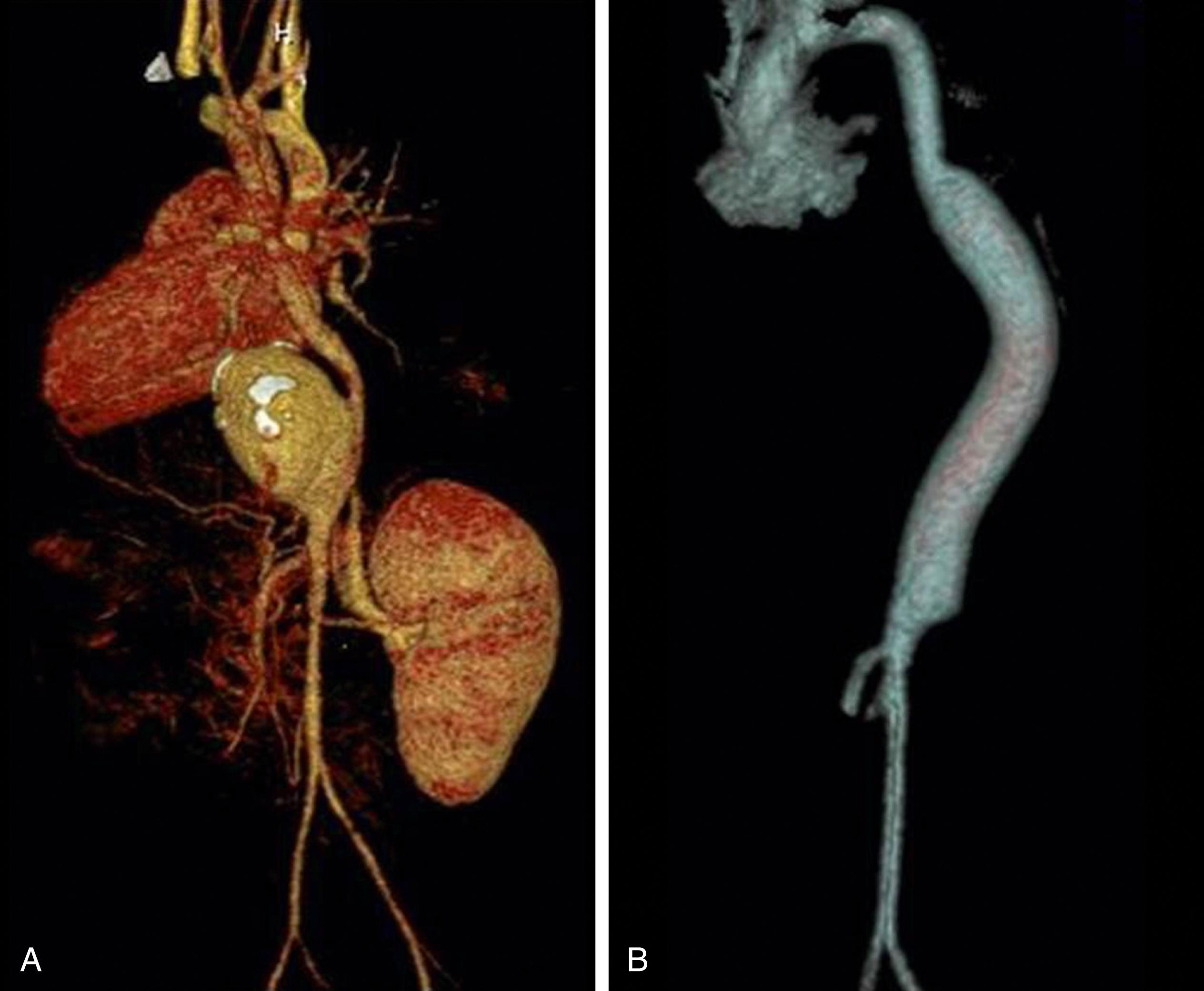 Figure 186.4, ( A ) Saccular mycotic aneurysm of the supraceliac abdominal aorta in a 20-month-old associated with infected umbilical artery catheterization (computed tomography angiography). ( B ) Magnetic resonance angiography following aneurysmectomy and repair with interposition 12-mm expanded polytetrafluoroethylene graft.