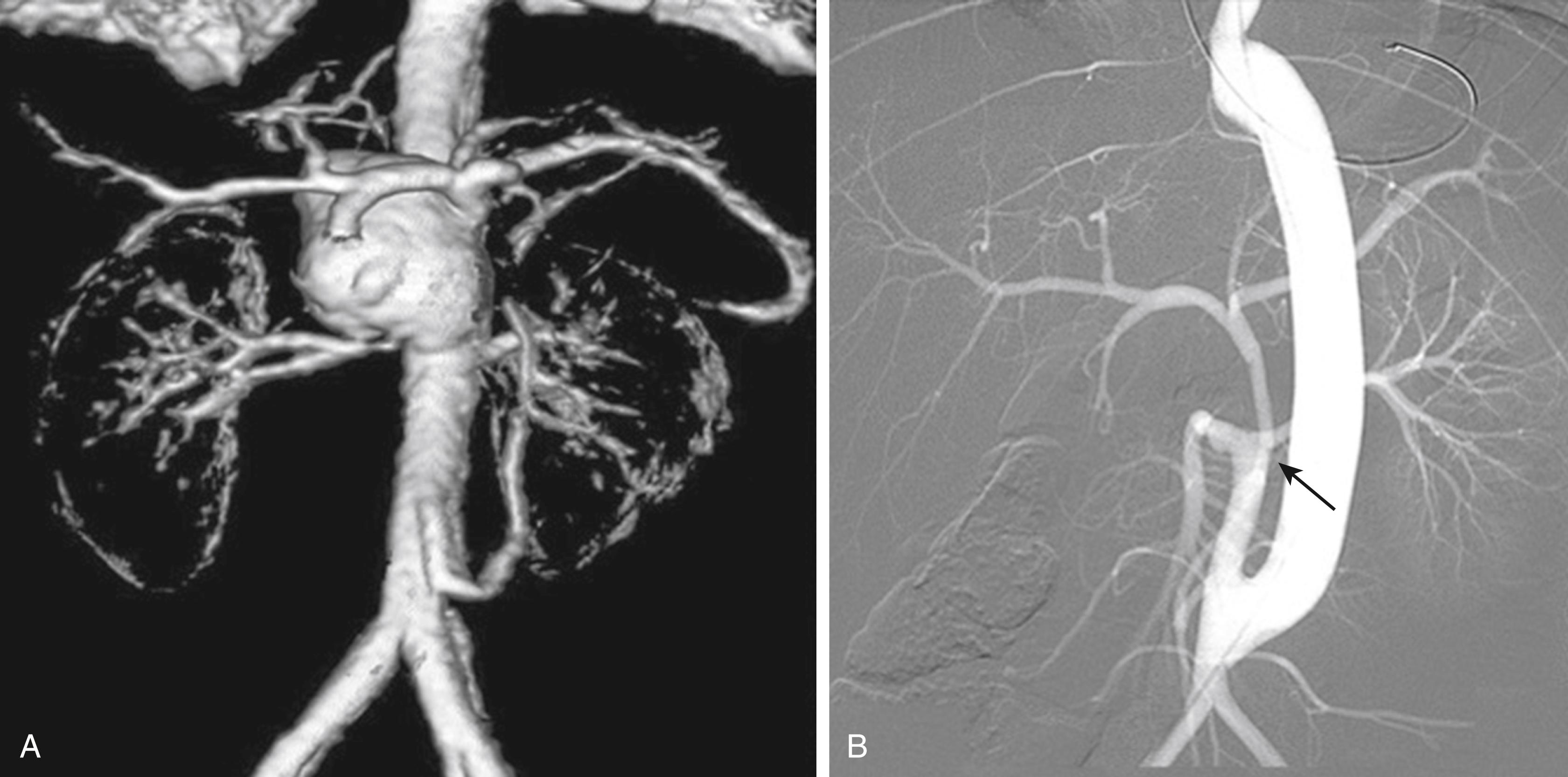 Figure 186.5, ( A ) Central abdominal aortic aneurysm with involvement of the celiac, superior mesenteric, and renal arteries associated with tuberous sclerosis in a 5-year-old (computed tomography angiography). ( B ) Treatment included aneurysmectomy, 14-mm expanded polytetrafluoroethylene thoracoabdominal bypass, aortic reimplantation of a left renal artery and superior mesenteric artery (SMA), and aortoceliac bypass with a hypogastric artery graft, all from the distal abdominal aorta (arrow) , as well as a right nephrectomy (digital subtraction arteriography).