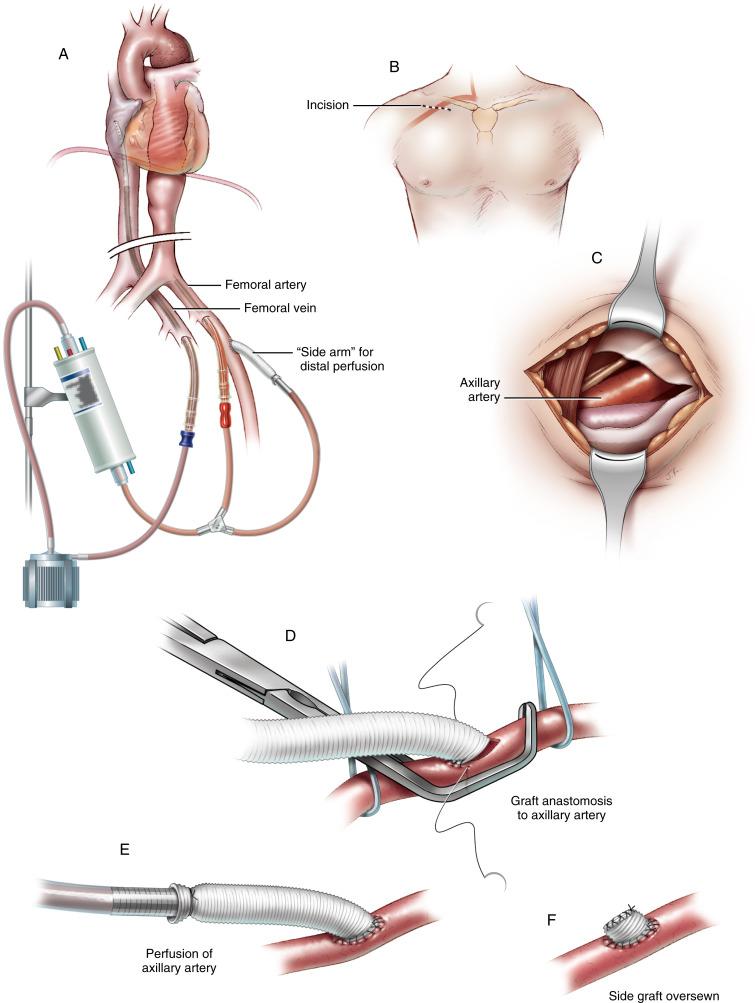 Figure 38-2, A Femoral-femoral bypass is instituted by placing an arterial cannula in the common femoral artery and a venous return cannula in the common femoral vein. For patients with small or diseased arteries, construction of a “side arm” with a prosthetic graft ensures distal perfusion of the leg. When using this strategy in acute aortic dissection, the surgeon should select the artery with the strongest pulse. High arterial pressure in the return cannula is strongly suggestive of impaired perfusion, and the cannula should be removed and placed in the opposite common femoral artery. B Antegrade perfusion via the right axillary artery is useful for operations on the aortic arch. It can be used as the sole method for arterial return during cardiopulmonary bypass, or it can be used to provide partial, selective antegrade cerebral perfusion during periods of hypothermic circulatory arrest. An oblique incision is made 1 cm below the right clavicle for exposure of the axillary artery. C The pectoralis major muscle is separated in the direction of its fibers to enter the subclavicular space. The artery is isolated with vascular loops, taking care to avoid injury to the brachial plexus. D A longitudinal incision is made in the artery. An 8 mm prosthetic graft is beveled and attached in an end-to-side fashion using continuous stiches of 5/0 polypropylene suture. E The graft is trimmed to about 20 cm in length, and a 22 F arterial return cannula is inserted into the graft. The cannula is secured with multiple ties around the graft and connected to the cardiopulmonary bypass circuit. Antegrade perfusion is delivered through the axillary graft to the right arm and the aortic arch. During periods of circulatory arrest, the innominate artery is clamped, and selective antegrade perfusion of the brain can be performed through the right common carotid artery. F When perfusion through a side graft is discontinued, the graft is clamped close to the artery, divided, oversewn with continuous stitches of 4/0 polypropylene, and sealed with BioGlue. G In cases of acute aortic dissection, central cannulation can be safely performed using the Seldinger guidewire technique. Under transesophageal echocardiographic guidance, a needle is placed directly into the distal ascending aorta, and the guidewire is advanced into the true lumen. H Successive dilation is performed over the guidewire, and the arterial cannula is placed through the aortic arch into the descending thoracic aorta. This ensures antegrade perfusion of the true lumen and avoids potential malperfusion and the differential flow patterns that can be associated with femoral artery cannulation.