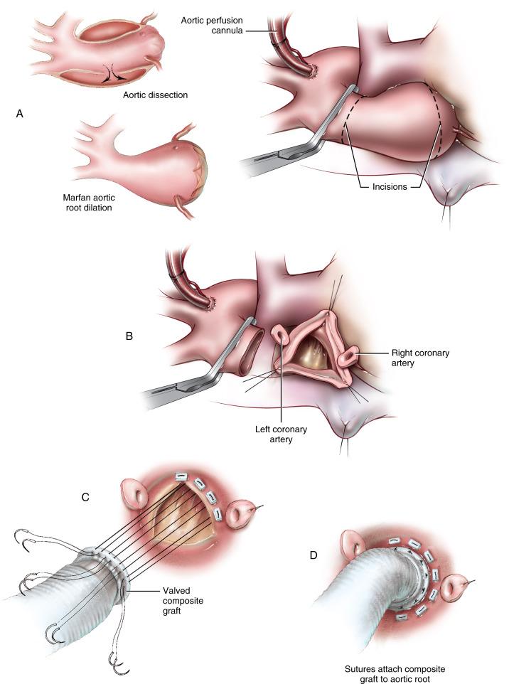 Figure 38-4, A The arterial perfusion cannula is placed in the distal ascending aorta or proximal aortic arch, depending on the extent of the ascending aortic aneurysm. The cross-clamp is placed in the ascending aorta distal to the aneurysm, and retrograde cardioplegia is used to arrest the heart. The aorta is transected 1 cm above the sinotubular junction and 1 cm from the aortic cross-clamp. The aneurysmal aorta is resected. B The aortic valve is excised, and the aortic root exposure is enhanced by placing traction sutures at the top of each commissure. The aortic tissue is removed from each sinus, leaving a 5 to 6 mm rim of aortic tissue along the aortic annulus. The left and right coronary arteries are mobilized on generous buttons of aortic sinus tissue. C The diameter of the aortic annulus is measured, and a mechanical valved composite graft is selected for the repair. A porcine aortic root prosthesis can also be used. Interrupted mattress stitches of 2/0 braided suture are placed down through the aortic annulus and brought up through the sewing ring of the prosthesis. Suture placement is started in the right coronary sinus and proceeds in a clockwise fashion, similar to standard aortic valve replacement. Repair of the left coronary sinus follows in a counterclockwise fashion, and the repair is completed in a clockwise fashion through the noncoronary sinus. D The valved composite prosthesis is lowered down on the aortic annulus, ensuring that the valve is seated properly without impinging on the leaflets or valve occlusion mechanism. The sutures are tied down first in the noncoronary sinus in a counterclockwise fashion. The second group of sutures in the left coronary sinus is tied in a counterclockwise fashion, and the repair is completed in the right coronary sinus in a clockwise fashion. A running suture technique is also acceptable, provided the annulus is strong enough to support this type of repair. E Openings are made into the sides of the Dacron graft exactly opposite the coronary artery ostia using a battery-operated ophthalmic cautery unit. Large openings make the technical aspects of the repair easier and avoid narrowing the anastomosis. An adequate amount of graft should be left between the bottom of these openings and the sewing ring of the prosthesis. The left coronary ostium is attached first using continuous stitches of 5/0 polypropylene. All the suture loops are placed around the inferior rim of the coronary ostium before they are tightened in order to accurately approximate the ostium to the graft opening. F Both coronary ostia are approximated to the graft in a similar fashion. The right coronary artery anastomosis can be completed either before or after the distal aortic anastomosis if there is concern about the proper orientation of the right coronary artery. G Secure, accurate stitches must be placed in the coronary artery button wall for secure approximation to the side of the graft. The stitches are placed in a “wagon wheel” fashion, taking wide bites of the surrounding Dacron graft or bioprosthetic aortic sinus tissues. This is particularly important in the case of aortic dissection, because the aortic tissue can be fragile. Use of BioGlue or Teflon felt “washers” is advised to support these critical coronary reimplantations. H When there has been extensive dissection into the coronary arteries, the main coronary arteries must be trimmed to some degree. Small, short interposition PTFE grafts can then be used to compensate for the loss of coronary artery length. The interposition grafts are attached in an end-to-end fashion to each main coronary artery using continuous stitches of 6/0 polypropylene sutures; then the grafts are attached to the openings in the composite graft using continuous stitches of 5/0 polypropylene suture. Careful attention must be paid to the length of each interposition graft to avoid kinking and improper orientation. BioGlue is applied to reinforce these suture lines. An alternative method is to use a single interposition graft for the reimplantation. The left main coronary artery (LCA) is trimmed back to healthy tissue, and a small prosthetic graft is attached in an end-to-end fashion using continuous stitches of 6/0 polypropylene. This prosthetic graft is then routed behind the main composite graft and attached to the front of it using continuous stitches of 4/0 polypropylene. The right coronary artery (RCA) is also trimmed back to healthy tissue, and a small opening is made in the side of the small prosthetic graft. The right coronary artery is attached to the side of the graft using continuous stitches of 6/0 polypropylene. In cases of Marfan type aortic aneurysm, the coronary ostia may be widely separated by the size of the aneurysm of the aortic root. An interposition graft may be anastomosed directly to the aorta around the coronary ostia without resection of part of the root aneurysm. The interposition graft may be anastomosed to the posterior aspect of the aortic graft, or interiorly as seems best. I The distal end of the graft is trimmed to an appropriate length and attached in an end-to-end fashion using continuous stitches of 4/0 polypropylene sutures. The suture line is first constructed across the back wall of the aorta and then carried up to the front of the anastomosis. J A short “collar” of graft material is used to support the distal anastomosis. The collar must be cut and placed around the graft prior to construction of the anastomosis. The collar is pulled up to cover the anastomosis and BioGlue is inserted beneath the collar to reinforce the suture line. K In patients in whom it is desirable to avoid anticoagulation, concomitant replacement of the aortic root with a Freestyle tissue bioprosthesis provides an excellent alternative to a composite mechanical valved conduit. The initial part of the operation is identical to that for aneurysmal disease of the ascending aorta and aortic root. The arterial return cannula is inserted into the distal aortic arch, and the ascending aorta is resected. L The aortic root is prepared after placing traction sutures at the top of each commissure. All diseased aortic sinus tissue is removed, and the coronary arteries are mobilized on generous buttons of aortic tissue. The aortic annulus diameter is measured, and an appropriate Freestyle porcine aortic root bioprosthesis is selected. The diameter top of the Freestyle graft is measured, and a prosthetic graft of similar diameter is selected for the ascending aortic repair. M A short period of circulatory arrest under deep hypothermia is required to construct the distal aortic anastomosis. After trimming the distal aorta in a hemiarch manner, a prosthetic graft is beveled and attached in an end-to-end fashion using continuous stitches of 4/0 polypropylene. The Freestyle sizer is inserted inside the graft to distend the suture line, and BioGlue is applied to reinforce the anastomosis. Cardiopulmonary bypass is reinstituted at low flow. After air and debris are removed from the aortic arch, the graft is clamped, and full cardiopulmonary bypass is reinstituted. N The Freestyle porcine aortic root bioprosthesis is attached to the left ventricular outflow tract using continuous 3/0 polypropylene sutures. The bioprosthesis is aligned in an anatomic fashion, with the stumps of the porcine left and right coronary arteries facing the native coronary buttons. The suture line is begun at the commissure between the left and right sinuses. The suture is brought in a clockwise fashion along the right coronary sinus to the halfway point of the noncoronary sinus, taking generous bites of the aortic annulus and bringing the needle up through the collar of the Freestyle tissue bioprosthesis just below the dashed marker line. The other end of the suture is brought in a counterclockwise fashion along the left coronary sinus to the halfway point of the noncoronary sinus, meeting the previous suture. Silk sutures are looped around every third stitch, acting as “pulleys” that are gently tightened as the bioprosthesis is lowered into position. This ensures even, symmetric tightening of the anastomosis without breaking the suture. BioGlue is used to reinforce the suture line. O The left coronary stump of the Freestyle porcine aortic root bioprosthesis is removed to create an opening in the porcine root. The left coronary ostium is attached using continuous 5/0 polypropylene sutures. Several suture loops are placed along the inferior rim of the left coronary ostium before tightening the suture line; this ensures precise placement of the stitches. The right coronary stump of the Freestyle bioprosthesis usually does not align exactly opposite the patient’s right coronary artery. A second opening is made in the right coronary sinus of the bioprosthesis at the approximate location, and the right coronary ostium is attached in a similar fashion. Both coronary artery anastomoses are reinforced with BioGlue. P The bioprosthetic graft is trimmed to appropriate length and beveled to match the bevel of the aorta. Beveling re-creates the natural contour of the ascending aorta, forming a small curvature on the central or leftward part of the graft. Q The Freestyle tissue bioprosthesis is attached to a prosthetic graft using continuous stitches of 4/0 polypropylene. A short “collar” of graft is used to support the anastomosis. The collar is cut from the unused portion of the graft and must be placed over the graft prior to performing the anastomosis. The collar is pulled over the completed anastomosis and BioGlue is inserted beneath the collar to reinforce the suture line.