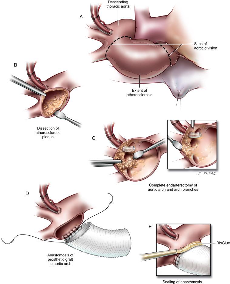 Figure 38-5, A An aortic perfusion cannula is placed in the distal part of the aortic arch, with the tip in the upper portion of the descending thoracic aorta beyond the origin of the left subclavian artery. A two-stage venous uptake cannula is placed in the right atrium. The patient is perfused with blood cooled to 12 o C until the body temperature (nasopharyngeal) reaches 16 to 18 o C. An induction dose of thiopental sodium (Pentathol), corticosteroids, and mannitol are useful pharmacologic adjuncts. Circulatory arrest under these conditions should be well tolerated for 60 minutes. This period can be extended by interval hypothermic perfusion of the brain. Some surgeons favor retrograde cerebral perfusion via the superior vena cava as a means of cerebral protection, but data on the efficacy of this method are not conclusive. An occlusion clamp is placed on the ascending aorta when ventricular fibrillation occurs. The occlusion clamp must be placed on a disease-free area; this can be determined by gentle palpation of the aorta. The best spot is often just above the sinotubular junction. A vent catheter is placed in the left superior pulmonary vein and passed into the left ventricle. Retrograde perfusion of the coronary sinus is begun, and the heart is cooled to 4 o C. When the target body temperature is reached, cardiopulmonary bypass is discontinued. The occlusion clamp is removed from the aorta. The aorta is divided above the sinotubular junction. It is divided distally just proximal to the origin of the brachiocephalic artery in an oblique manner across to the inferior aspect of the aortic arch, including part of the arch. B A dissection plane is opened between the aortic intima-media and the adventitia, working through the open end of the aorta. C Endarterectomy of the portions of the arch affected by atherosclerotic disease is performed. Removal of all the arch intima and media may be required, extending the dissection into the arch branches. A smooth transition to the arterial intima, with firm attachment, must be present at the end points of the endarterectomy. Extending the endarterectomy into the branch vessels beyond visualization (blind endarterectomy) may be required, but this adds risk to the procedure. D A tubular Dacron vascular graft is tailored obliquely when part of the arch has been removed. The short angle of the graft is placed medially on the aortic arch to avoid kinking as the graft is brought down to the aortic root. An end-to-end anastomosis of the graft to the aortic arch is constructed using continuous stitches of 4/0 polypropylene. E The anastomosis is sealed with BioGlue. Cardiopulmonary bypass is resumed, with the patient in a head-down position. Air and debris are removed from the arch and its branches by gentle agitation and floated out the open proximal end of the graft. An occlusion clamp is placed on the graft. The proximal anastomosis of the graft to the proximal aorta is completed during the rewarming process.