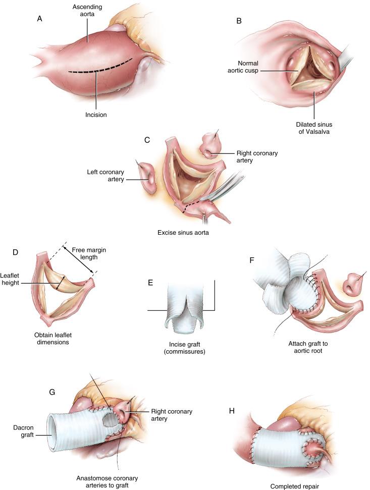 Figure 38-6, A Cardiopulmonary bypass is established as usual. The aorta is occluded and retrograde cold cardioplegia given through the coronary sinus. The aneurysm of the ascending aorta is incised longitudinally. The aorta is divided distally above the aneurysm. B The aortic valve is inspected to determine the feasibility of repair. If the aneurysmal disease is restricted to the aorta, with dilation of the sinuses of Valsalva, it may be possible to preserve the aortic valve. The aortic valve cusps should be normal. There should be no dilation of the aortic annulus, although there are techniques to narrow the annulus. In the situation depicted here, the aortic valve is determined to be incompetent due to separation of the commissures by aneurysmal dilation of the aorta. C The sinus aorta is excised, retaining only a 3 to 5 mm rim above the fibrous connecting point of the aortic valve (annulus). A button of sinus aorta is retained around ostia of the left and right coronary arteries. D Average dimensions of the aortic leaflets are obtained. The length of the free margin of the leaflets is determined, and the height of the leaflets is measured. The sinotubular diameter is calculated using dimensions determined by Kunzelman: if the diameter of the aortic root at the ventriculoaortic junction (“the “annulus”) is taken as 1.0, the diameter of the sinotubular junction (which will also be the diameter of the prosthetic graft chosen for the repair) is 0.91 of the annulus diameter. For example, if the diameter of the aortic valve annulus measures 25 mm, a 22 mm diameter tubular prosthesis is chosen (25 × 0.9 = 22.5). A practical method for selecting an appropriately sized prosthetic graft is to simply measure “the annulus,” as would be done for an aortic valve replacement, and choose a tubular graft diameter that is about 90% of the diameter of the annulus. E A graft of the appropriate size is selected. Double-velour knitted Dacron that has been collagen coated for hemostasis is usually chosen. The graft is cut at three symmetric points to accommodate the commissures of the aortic valve. The cuts usually extend six or seven crimp ridges into the graft, depending on the height of the leaflets. The graft material between these cuts will become the reconstructed sinuses of Valsalva. F The edges of the graft are attached to the sinus aortae remnant at the hinge point of the aortic leaflets. Continuous stitches of 3/0 or 4/0 polypropylene are used for the repair. The commissures of the aortic valve are brought into the apices of the cuts in the graft. G Openings are cut into the graft, opposite the location of the coronary arteries, using a hot cautery. The coronary arteries are anastomosed to the openings in the graft with continuous stitches of 5/0 polypropylene. H An end-to-end anastomosis of the graft to the aorta completes the repair. All vascular anastomoses are sealed with BioGlue.