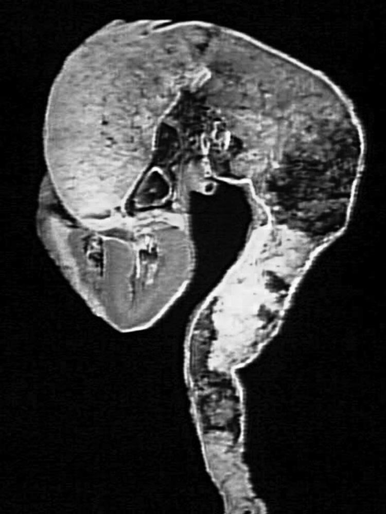 Fig. 56.1, Massive thoracic aortic aneurysm. Note that the size of the aneurysm dwarfs that of the heart.