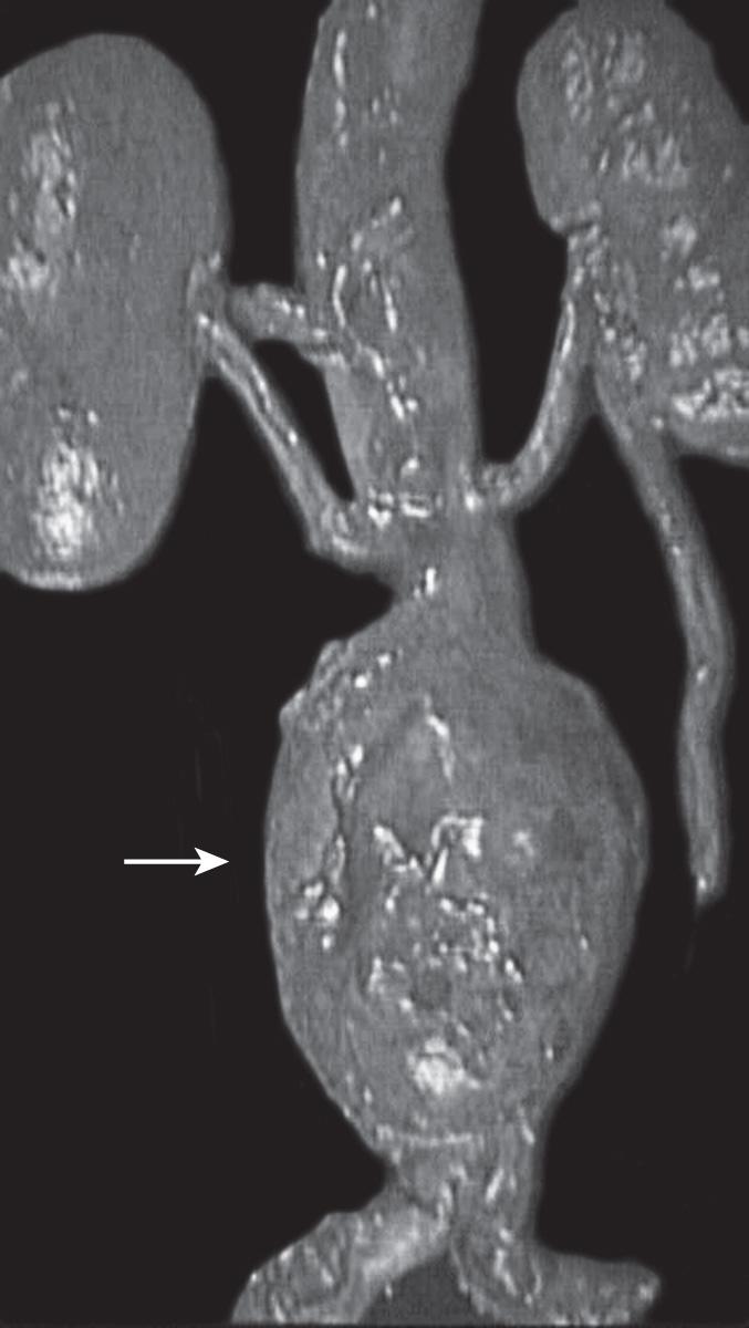 Fig. 56.2, Abdominal aortic aneurysm (arrow) .