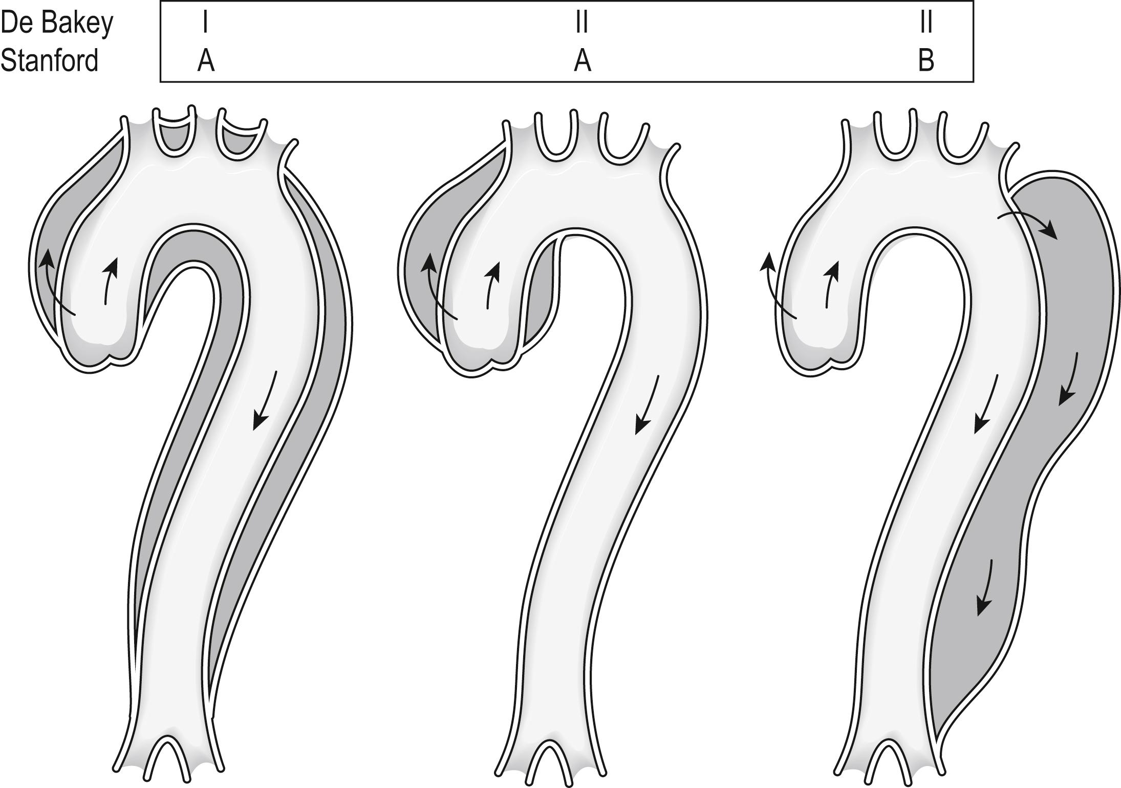 Fig. 5.10.1, Anatomical classification of aortic dissection.