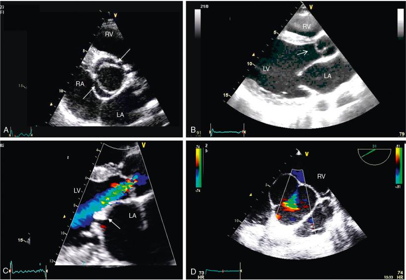 Fig. 10.1, Role of Echocardiography in Diagnosing the Cause of Aortic Regurgitation (AR).