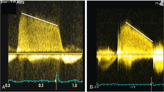 Fig. 10.2, Continuous-Wave Doppler Curves.