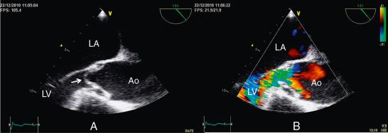 Fig. 10.3, Aortic Regurgitation (AR) in a Patient With Ascending Aorta Dissection.