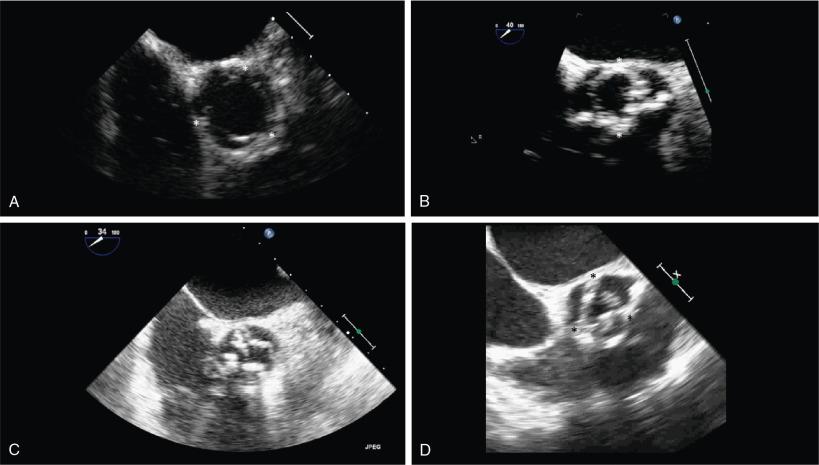 Fig. 9.2, Anatomic Features of Aortic Stenosis for Different Causes During Systole.