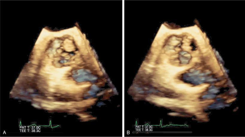 Fig. 9.3, Three-Dimensional (3D) Echocardiography in Aortic Stenosis (Video 9.3 ).