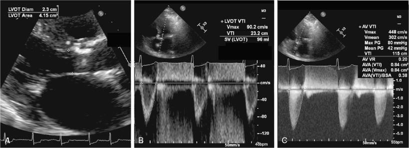 Fig. 9.6, Aortic Valve Area (AVA) Calculated by Echocardiography.
