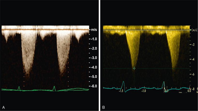 Fig. 9.7, Comparison of Aortic Stenosis and Hypertrophic Cardiomyopathy Spectral Waveform.