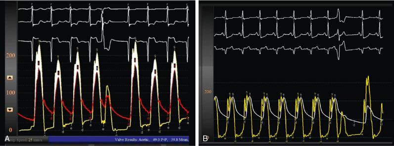 Fig. 9.8, Comparison of Aortic Stenosis (AS) and Hypertrophic Cardiomyopathy During Hemodynamic Catheterization.