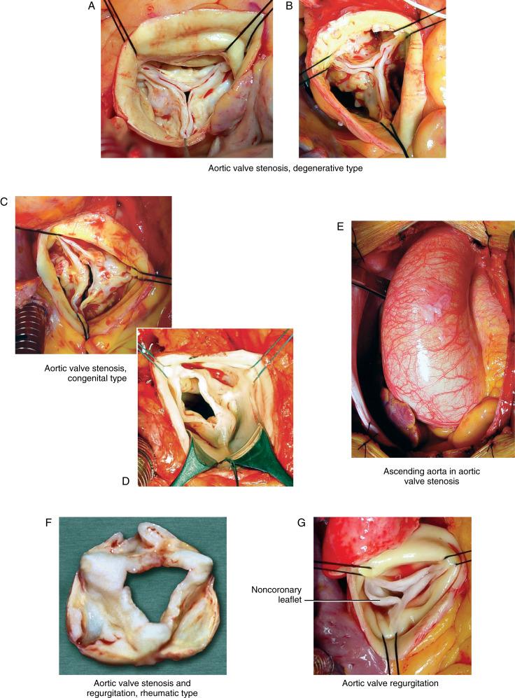 Figure 31-1, A Operative image of aortic valve stenosis, degenerative type. Normal three-leaflet architecture is maintained. Commissures are not fused. Leaflets are held in a closed position due to diffuse, nodular calcific deposits. Calcification, often described as “eggshell,” may involve the sinuses of Valsalva. This morphology is presumed to be atheromatous. B Operative image of aortic valve stenosis, degenerative type. There are three leaflets and no commissural fusion. The degeneration is advanced, with marked nodular calcification. As aortic valve degeneration progresses, the aortic valve area decreases at a rate of 0.12 cm 2 /year. C Operative image of aortic valve stenosis, congenital type. The valve is bicuspid, with fusion of the commissure between the left and right coronary leaflets. There is heavy dystrophic calcification of the leaflets. The valve orifice is eccentric and slit-like. D Operative image of aortic valve stenosis, congenital type. There is only one open commissure, that between the left and noncoronary leaflets. The other two commissures are completely fused. This may be called a unicuspid valve. Calcification is not as severe as in Part C . E Operative image of the ascending aorta in aortic valve stenosis. The aorta is frequently abnormal in patients with bicuspid aortic valve. This image shows dilation of the ascending aorta. F Aortic valve stenosis and regurgitation, rheumatic type, in an excised valve specimen. Normal three-leaflet structure is retained. There is scarring and shortening of the leaflets with rolling of the free edges, resulting in central regurgitation due to a lack of leaflet coaptation. The thickened leaflets also obstruct left ventricular outflow (aortic valve stenosis). G Operative image of aortic valve regurgitation. The noncoronary leaflet of the aortic valve is redundant and prolapsed. Many cases of aortic valve regurgitation are caused by an abnormality of the aorta, primarily dilation, producing secondary changes in otherwise near-normal aortic valve leaflets. These cases are often amenable to repair by correcting the aortic morphology.