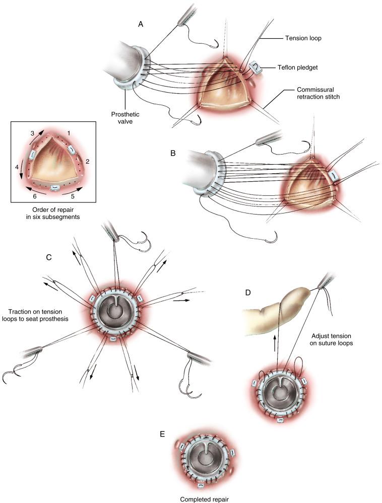 Figure 31-3, A Retraction stitches are placed just above the commissures. The aortic annulus is divided into three segments by the commissures. During the valve replacement procedure the annulus is subdivided at the midpoint on the annulus between the commissures to create six subsegments. A double-needle 2/0 polypropylene suture with a compressed Teflon pledget in the center of the suture is used. An initial mattress stitch is placed at the center of the sinus of Valsalva, through the aortic annulus, and brought through the sewing ring of the prosthesis. The prosthetic valve is held away from the annulus and positioned and retracted for added exposure. Exactly three stitches are placed between the initial pledget-reinforced stitch and the commissure on each side of the sinus. The final stitch at each end is secured to the wound drapes by a hemostat. A loop of 0 silk suture is placed around the polypropylene suture as the first suture loop is completed through the prosthesis in each subsegment. This silk loop is held by a hemostat and is later used to adjust tension on the suture line. B Sutures in the right coronary annulus are placed from the center toward the commissures in the first and second subsegments. The initial stitch in the left coronary sinus passes through the sewing ring of the prosthesis, opposite the last stitch of the second subsegment. Working from the center to the commissures in the left coronary sinus, the surgeon attaches the third and fourth subsegments to the prosthesis. Last, sutures are placed in the fifth and sixth subsegments in the noncoronary sinus. C Traction is placed on the six 0 silk loop sutures to pull the prosthesis into the annulus of the aortic valve. The pledget must be tightly approximated because this is the lowest point in the annulus and has the most tension when drawn up to the prosthesis. This is accomplished by pulling up on the loop sutures adjacent to the pledget to seat it firmly. Care must be taken not to draw the pledget beneath the prosthesis. D The silk traction suture loops are removed sequentially, and the ends of the polypropylene suture are pulled up tightly to approximate the sewing ring of the prosthesis precisely to the annulus of the aortic valve. The occluder of the prosthesis is opened, and the surgeon checks to ensure that there are no loose suture loops beneath the aortic prosthesis in the outflow tract of the left ventricle. This traction suture loop technique, which was devised by Dr. Russell M. Nelson, makes it easy to pull the prosthesis into the annulus of the aortic valve and tighten the continuous sutures. E A final check is performed to verify approximation of the sewing ring of the aortic prosthesis to the annulus of the aortic valve. Special attention is paid to accurate placement of the pledget, which should be above the annulus at the point of maximal stress, deep in the center of the sinus of Valsalva. The suture ends are then joined by a knot at the three commissures.