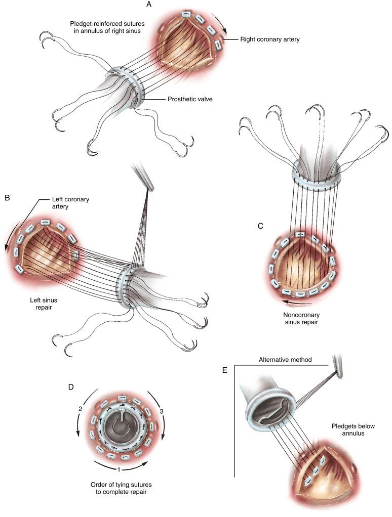 Figure 31-4, A A double-needle suture of synthetic material with a centrally placed, compressed Teflon pledget is used for the repair. Using sutures of two different colors (green or blue and white) simplifies intraoperative identification of the suture pairs. In this way, the sutures from each annulus repair beneath each sinus of Valsalva can be held together as a group. Mattress stitches are taken through the annulus of the aortic valve, beginning at the commissure between the left and right coronary cusps. Stitches are placed in the right coronary annulus in a clockwise fashion, working toward the commissure between the right and noncoronary sinuses. Separate stitches are placed close to one another, and the space along the aortic annulus is taken beneath the pledget of the mattress stitch. The prosthesis is held away from the aortic annulus until all stitches have been placed. B The annulus of the left coronary sinus of Valsalva is then approximated to the sewing ring of the aortic valve prosthesis. The sutures are placed in a counterclockwise fashion, beginning at the commissure between the left and right coronary cusps. C The annulus of the noncoronary sinus of Valsalva is approximated to the valve prosthesis, working in a clockwise fashion from the commissure between the right and noncoronary cusps toward the commissure between the left and noncoronary cusps. The needles are passed through the annulus in a backhand fashion. The three groups of sutures are then strongly retracted so that the prosthesis can be slid over the suture loops into the aortic annulus. The position of the occluder mechanism can be adjusted before the valve holder is removed. D The sutures are sorted and tied down in a specific order. First the sutures in the noncoronary sinus are tied down in a counterclockwise fashion. The first suture in the left coronary sinus closest to the commissure between the left and right coronary cusps is tied directly across the annulus from those sutures already tied in the noncoronary sinus, to ensure that the prosthesis is securely seated. The sutures of the left coronary sinus are then tied down in a counterclockwise fashion. To complete the repair, the sutures are tied in the right sinus in a clockwise fashion. If a portion of the valve prostheses projects below the sewing ring and is thus positioned partially below the annulus in the left ventricular outflow tract, the order of suture tying is altered so that those portions of the prosthesis below the annulus are secured first. E An alternative technique for placement of the pledget-reinforced stitches is used in cases of a small aortic annulus. The pledgets are placed below the annulus in the left ventricular outflow tract by placing a mattress stitch with a center pledget via a double-needle suture; the suture is passed from below the annulus and up through the prosthesis. A larger prosthesis is thereby secured above the annulus as the annulus is compressed between the sutures and the device.