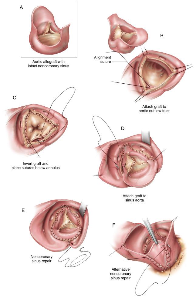 Figure 31-6, A The principles of aortic root anatomic assessment, valve excision, annular sizing, choice of allograft size, and method of trimming are exactly as described for the 120-degree rotation technique (see Figure 31-5 , A-D ), except that the noncoronary sinus of the graft remains intact and is not trimmed. A significant length of graft aorta is left above the sinus rim. This will be trimmed later during closure of the aorta. Transecting the aorta rather than using an oblique incision is probably preferable for the reasons explained earlier. B The graft is attached to the aortic outflow tract exactly as shown in Figure 31-5 , F . Only one alignment suture is shown here. The actual suture used for the repair is placed below the medial commissure. C The graft is lowered into the aortic outflow tract, and the aortic tissue is inverted to expose the lower edge of the graft. The lower suture line proceeds as demonstrated in Figure 31-5 , H and I . Shown here are the final stitches taken in the noncoronary sinus. An effort is made to keep the lower suture line in a level plane. Maintaining a level suture line is not possible in the segment of the right coronary sinus occupied by the conduction system; there, sutures must be placed through the fibrous annulus. Because many patients have deformed noncononary sinuses that are much deeper than the other sinuses, it may be necessary to adjust the position of the lower suture line in this segment. In some cases it is actually more desirable to bring the lower suture line above the annulus into the aortic sinus to compensate for the deformity, rather than distorting the graft by attempting to pull it down to achieve a subannular suture line, as described for the 120-degree rotation technique. D The sinus aorta of the graft is attached to the sinus aorta of the host using continuous stitches of 4/0 polypropylene. The suture line is started deep in the sinus at the midpoint with a horizontal stitch, as described in Figure 31-5 , J . The initial stitches the are placed deep in the sinus aorta to preserve sinus of Valsalva function. Suturing begins in the right coronary sinus and proceeds to the top of each adjacent commissure of the graft. Repair of the left coronary sinus follows. E Noncoronary sinus repair is accomplished by one of two methods. In one method, the aorta is closed over the graft if the noncoronary sinus of the host is enlarged and the graft will not be compressed or distorted by the repair. Continuous 4/0 polypropylene suture is used to close the aorta to a point above the sinus rim. The graft aorta is excised above the sinus rim. The aorta of the graft is closed to the host aorta just above the sinus rim by continuous sutures. F In the second method, if the noncoronary sinus of the host will not accommodate the graft without distortion, the edges of the aortotomy are left open to allow the graft sinus to expand without restriction. The edges of the aortotomy are loosely attached to the adventitia of the graft at an appropriate point. The graft is tapered and worked into the aortotomy closure above the sinus rim.