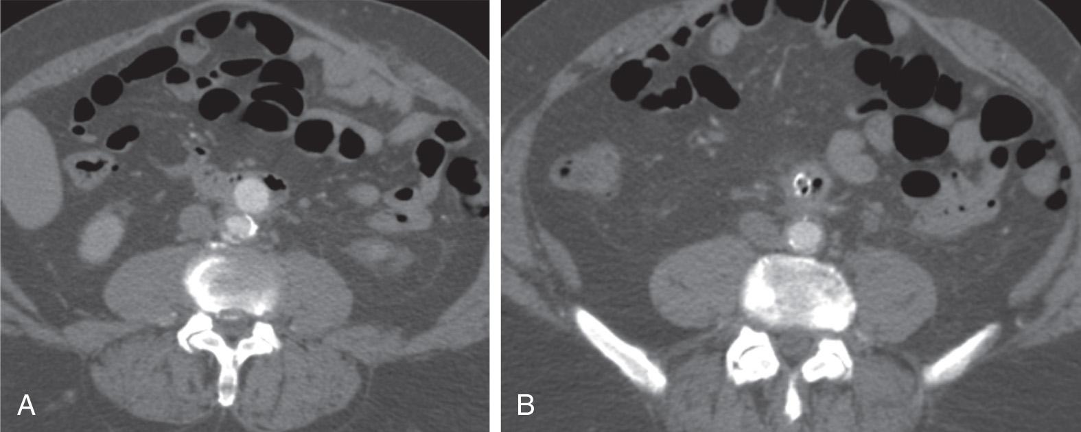 FIGURE 88.1, (A) The aortic portion of an end-to-side aortobifemoral bypass graft has eroded anteriorly and is located directly within the third portion of the duodenum. This is a 66-year-old man who presented with upper gastrointestinal bleeding. (B) Intraluminal air is demonstrated in the iliac limbs of the graft.