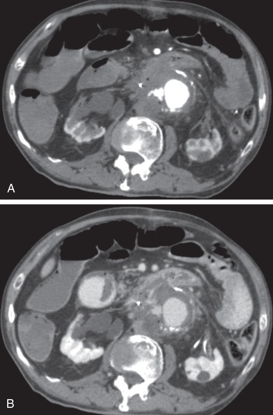 FIGURE 88.2, (A) Patient presented 6 weeks after an open repair of a 5.6-cm abdominal aortic aneurysm with hematemesis and syncope. Computed tomography scan reveals aortoenteric fistula between the aortic graft and the third portion of the duodenum. Air is seen external to the duodenum extending into the aortic graft. (B) Delayed venous-phase views reveal a large amount of contrast in the bowel, confirming active extravasation.