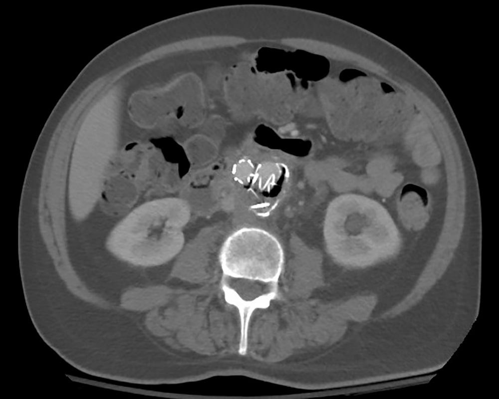 FIGURE 88.3, This 66-year-old male presented 3 years after an endovascular aneurysm repair with 6 weeks of back pain, abdominal pain, and intermittent fevers. Computed tomography scan shows air in the aneurysm sac. On exploration there was a duodenal-aortic erosion with purulence. The endograft was explanted and replaced with rifampin-soaked Dacron and the duodenum repaired primarily.