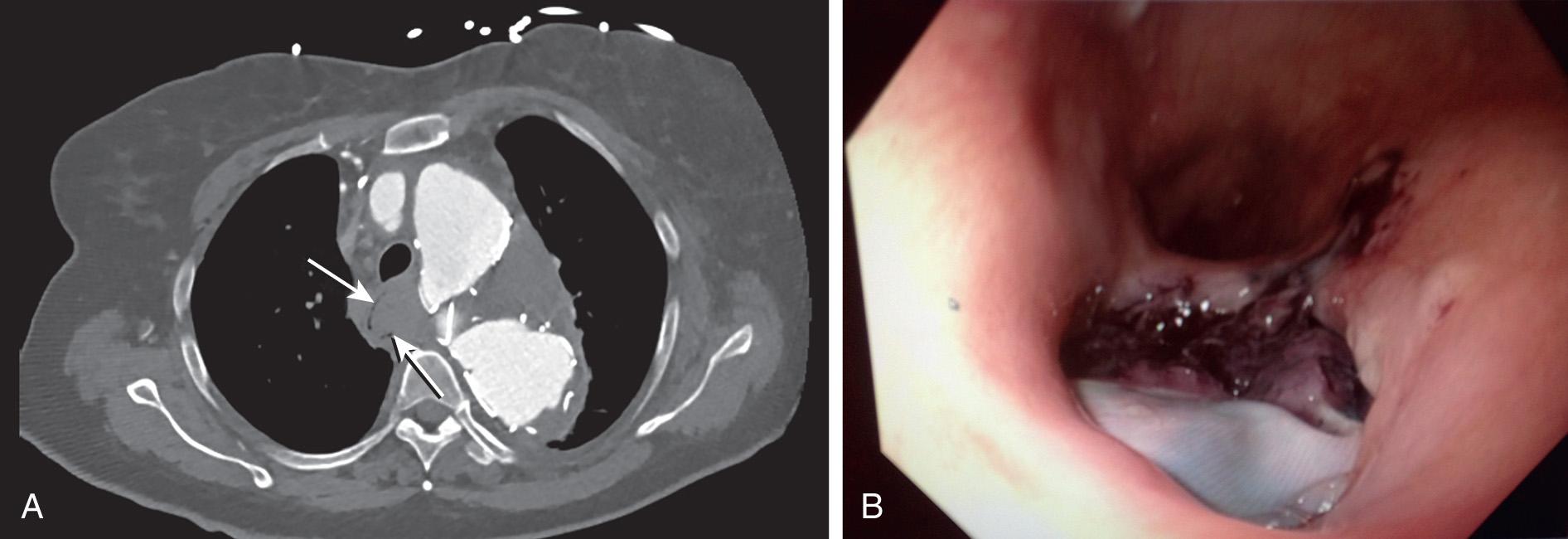 FIGURE 88.4, (A) A 78-year-old female underwent thoracic endovascular aneurysm repair and presented less than 2 years later with a low-volume gastrointestinal bleed. Computed tomography scan revealed a type 1 endoleak, aneurysm sac expansion, and suspicion for esophageal erosion. Arrows denote esophageal lumen impinged upon by inflammatory tissue and clot. (B) Upper endoscopy revealed a proximal esophageal ulcer with graft visible in the ulcer. Due to the patient's frailty, she was not a candidate for explant and aortic arch/esophageal reconstructions. She was treated with a carotid-carotid bypass, a midarch thoracic endograft, an esophageal stent, and lifelong antibiotic suppression.