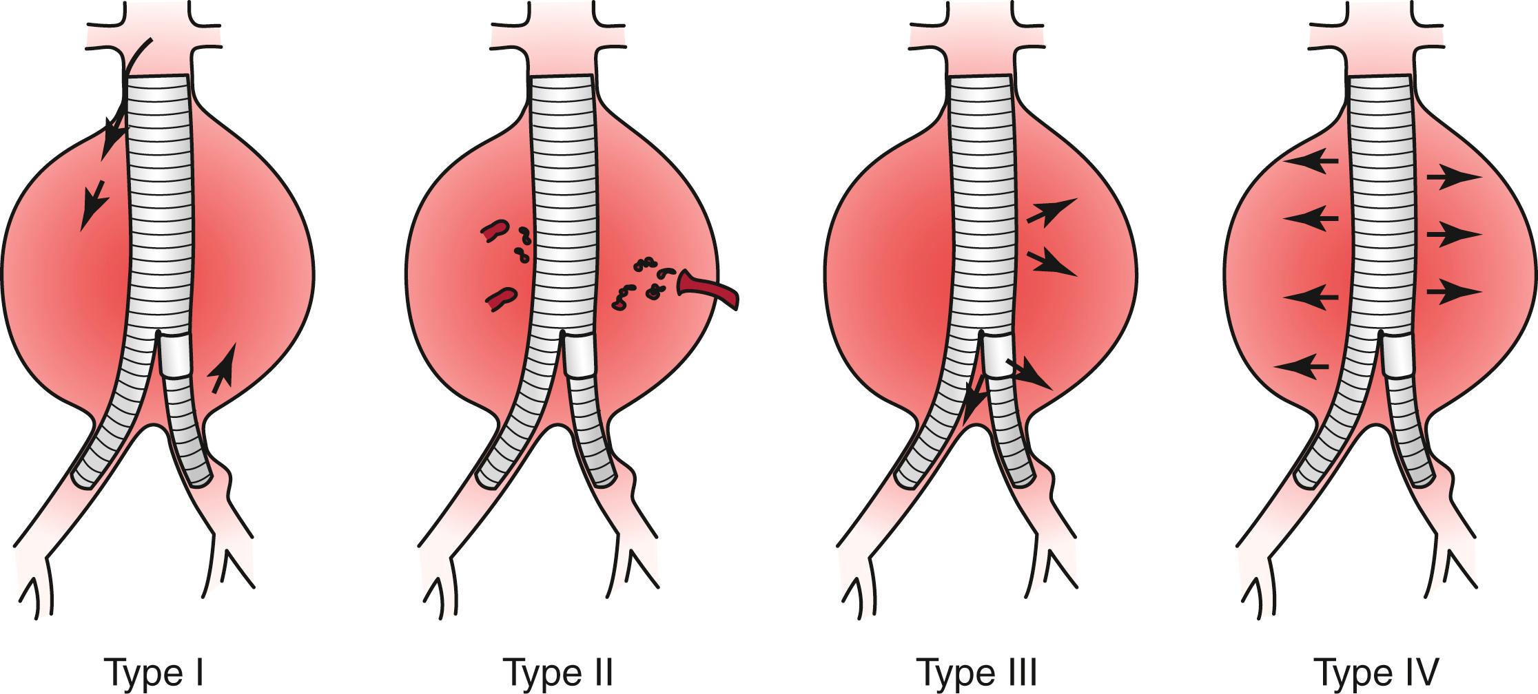 Figure 75.2, A Type I endoleak (periprosthetic) occurs at the proximal or distal attachment zones (or at both). A Type II endoleak is caused by retrograde flow from patent lumbar or inferior mesenteric arteries. A Type III endoleak arises from a defect in the graft fabric, an inadequate seal, or disconnection of modular graft components. A Type IV endoleak is due to graft fabric porosity, which often results in a generalized mild blush of contrast material within the aneurysm sac.