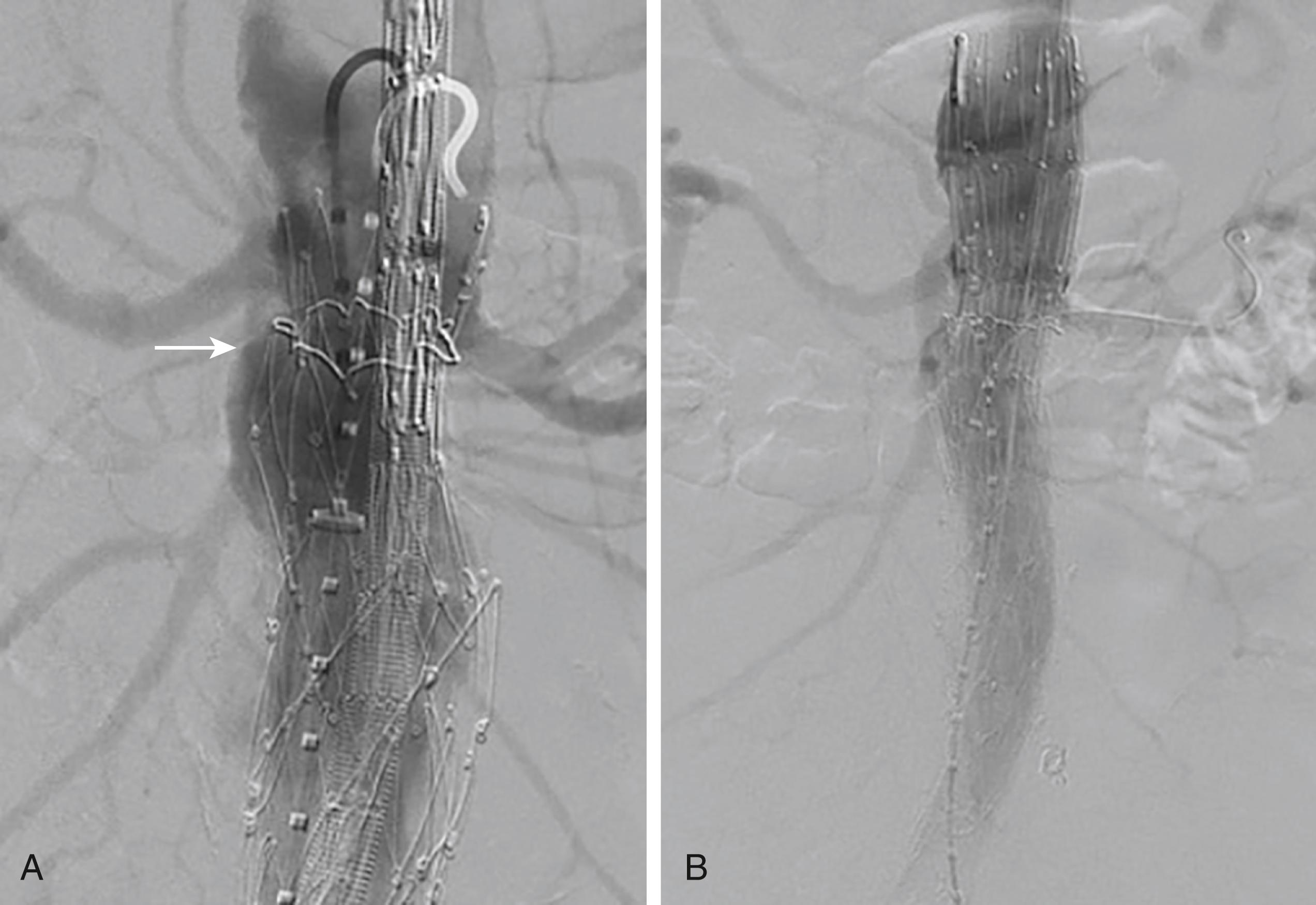 Figure 75.3, ( A ) Example of delayed type I endoleak secondary to proximal neck degeneration ( arrow ). ( B ) Treatment consisted of proximal extension with a Zenith fenestrated endograft.