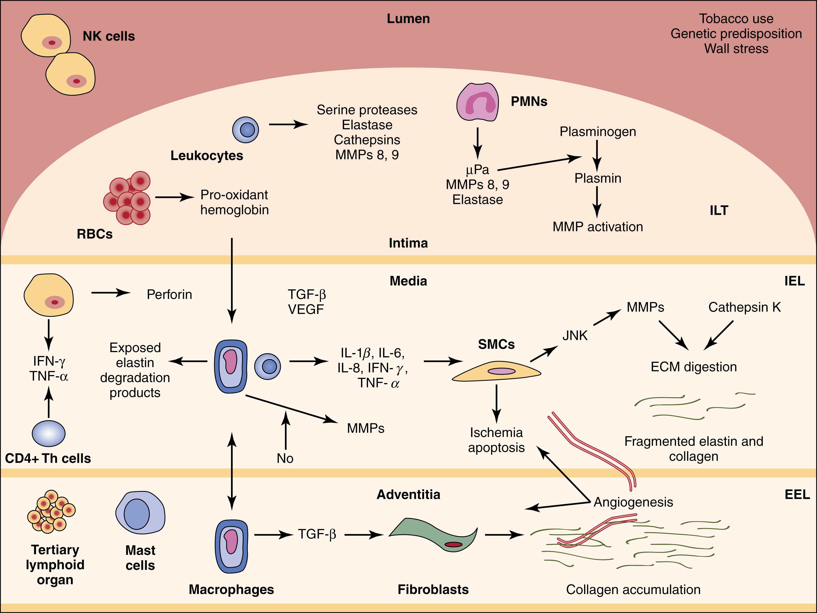 Figure 72.1, Schematic Diagram Demonstrating the Complexity of Abdominal Aortic Aneurysm Pathogenesis. 46 ECM , extracellular matrix; EEL , external elastic lamina; IEL , internal elastic lamina; IFN-γ, interferon-γ; IL , interleukin; ILT , intraluminal thrombus; JNK, c-Jun N-terminal kinase; MMP , matrix metalloproteinase; NK , natural killer cell; NO , nitric oxide; PMN , polymorphonuclear cell; RBC , red blood cell; SMC , smooth muscle cell; TGF-β, transforming growth factor-β; Th , T-helper cell; TNF-α, tumor necrosis factor-α; uPa , urokinase-type plasminogen activator; VEGF , vascular endothelial growth factor.