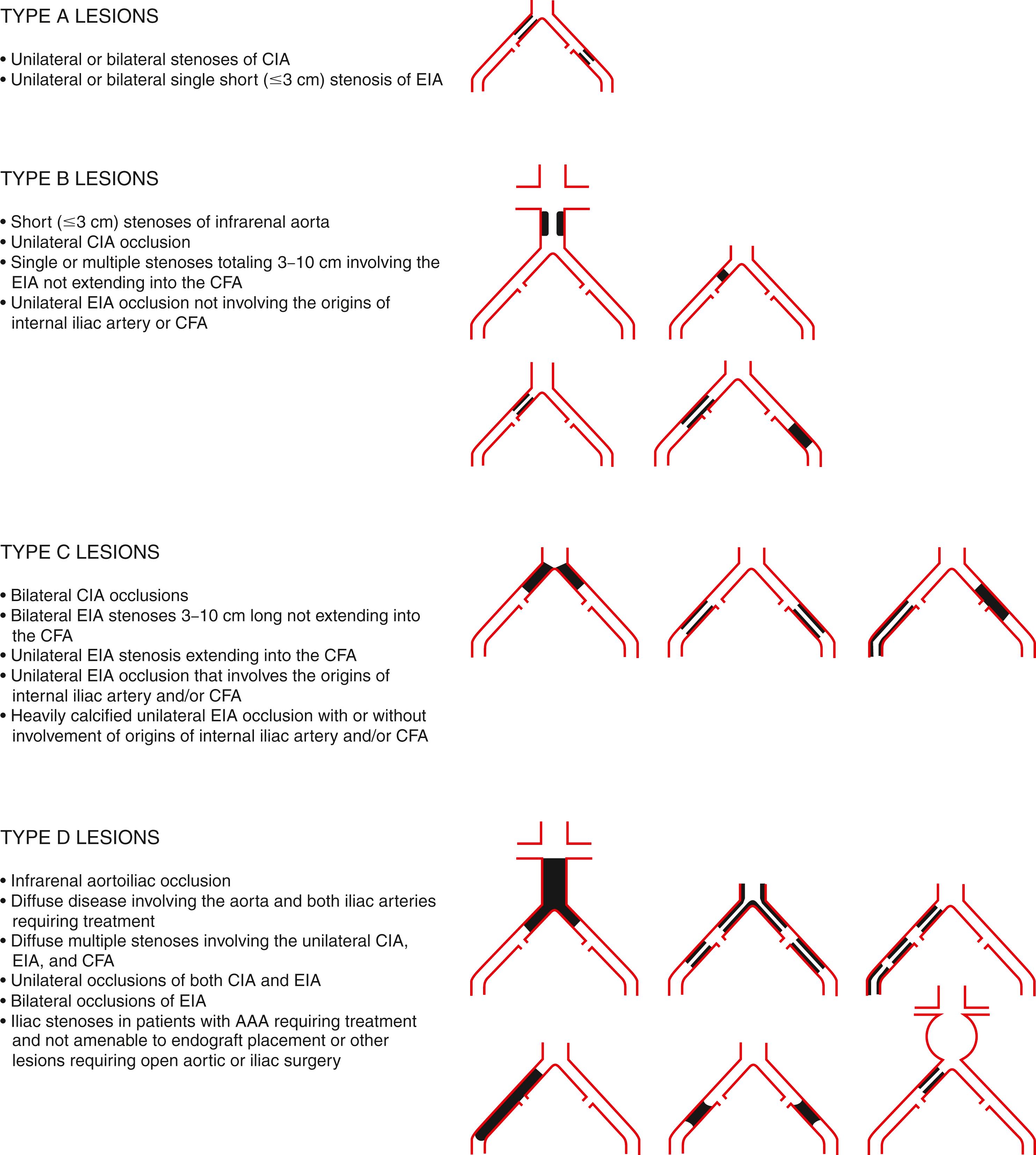 Figure 111.1, TASC Classification of Aortoiliac Lesions.