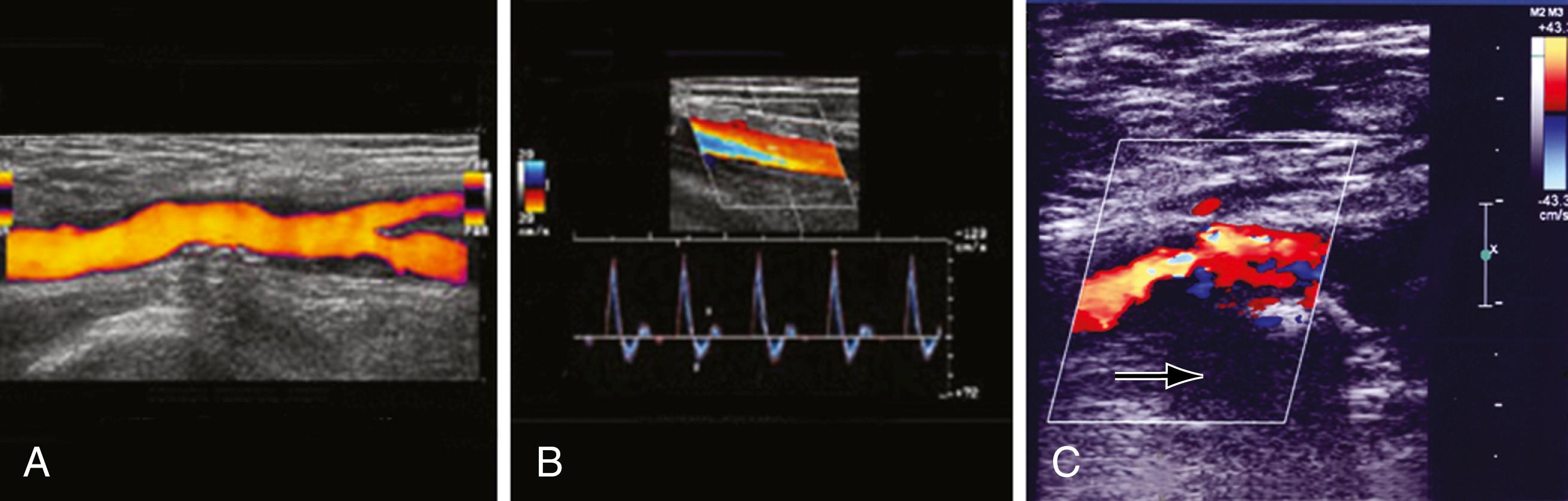 Figure 111.2, Duplex Mapping of the Common Femoral Artery.