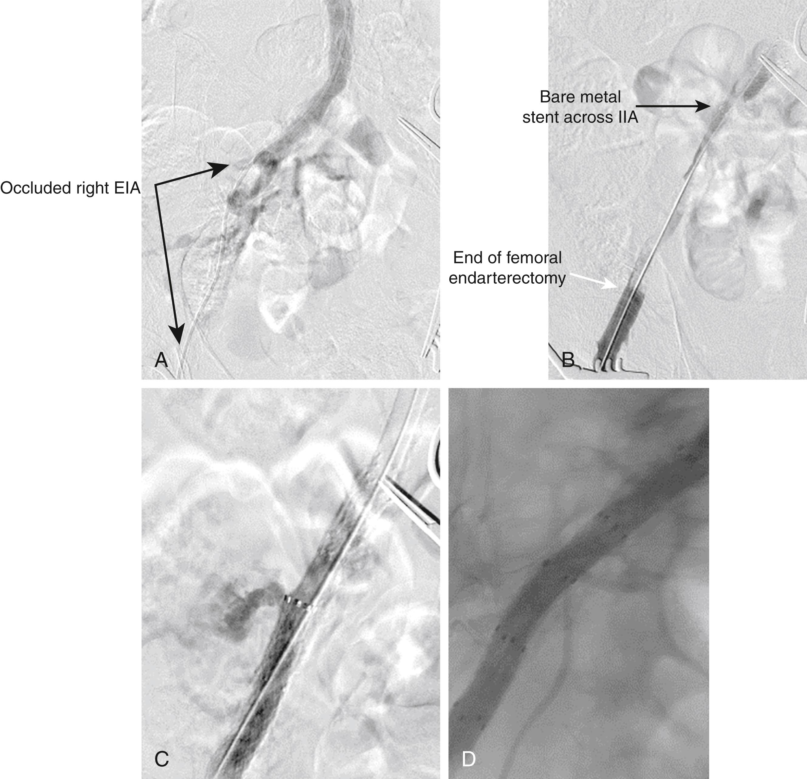 Figure 111.3, Ruptured External Iliac Artery Treated with a Stent Graft.