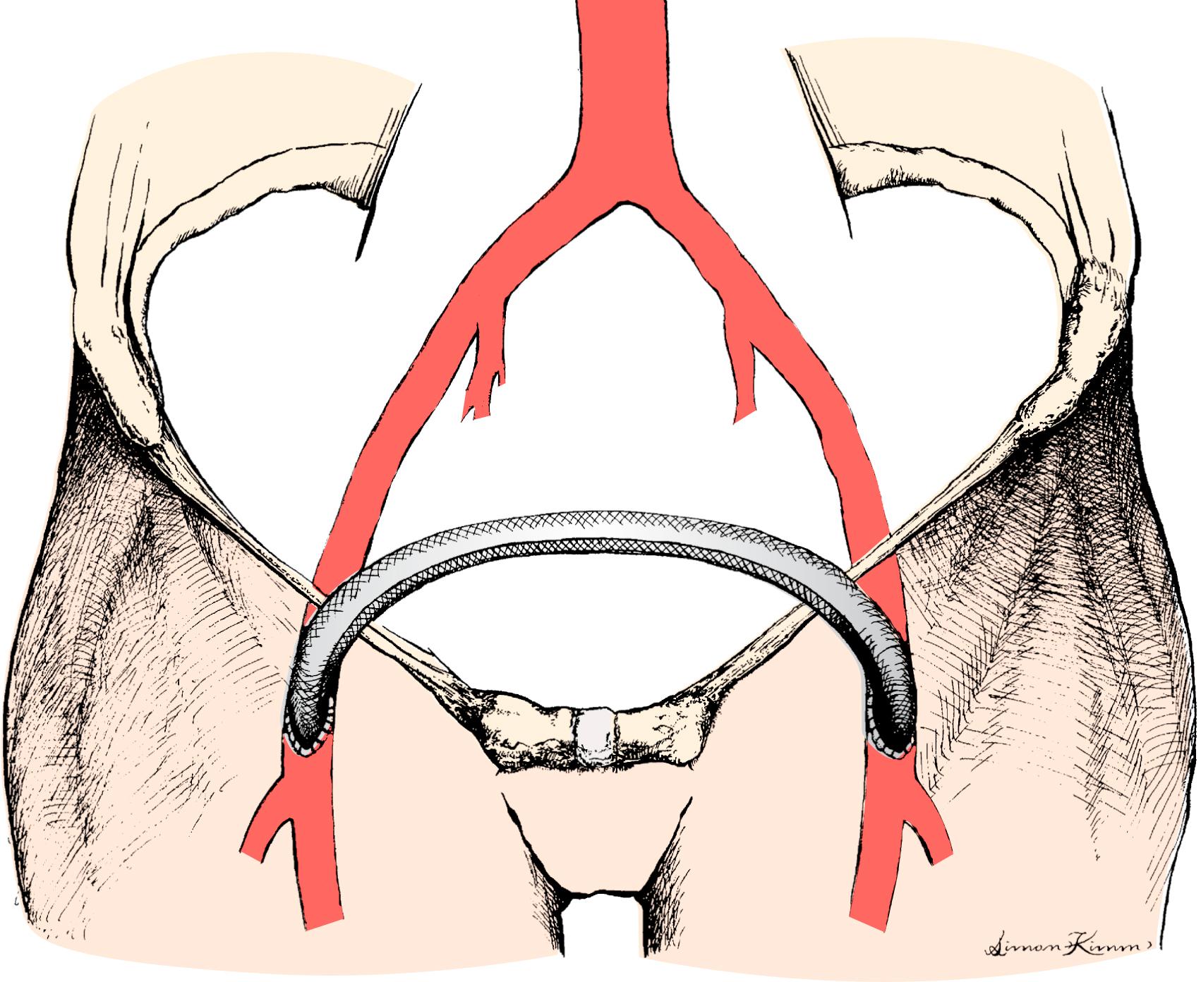 Figure 110.1, Standard “inverted C,” perhaps better termed “inverted U,” configuration of a femorofemoral bypass graft.