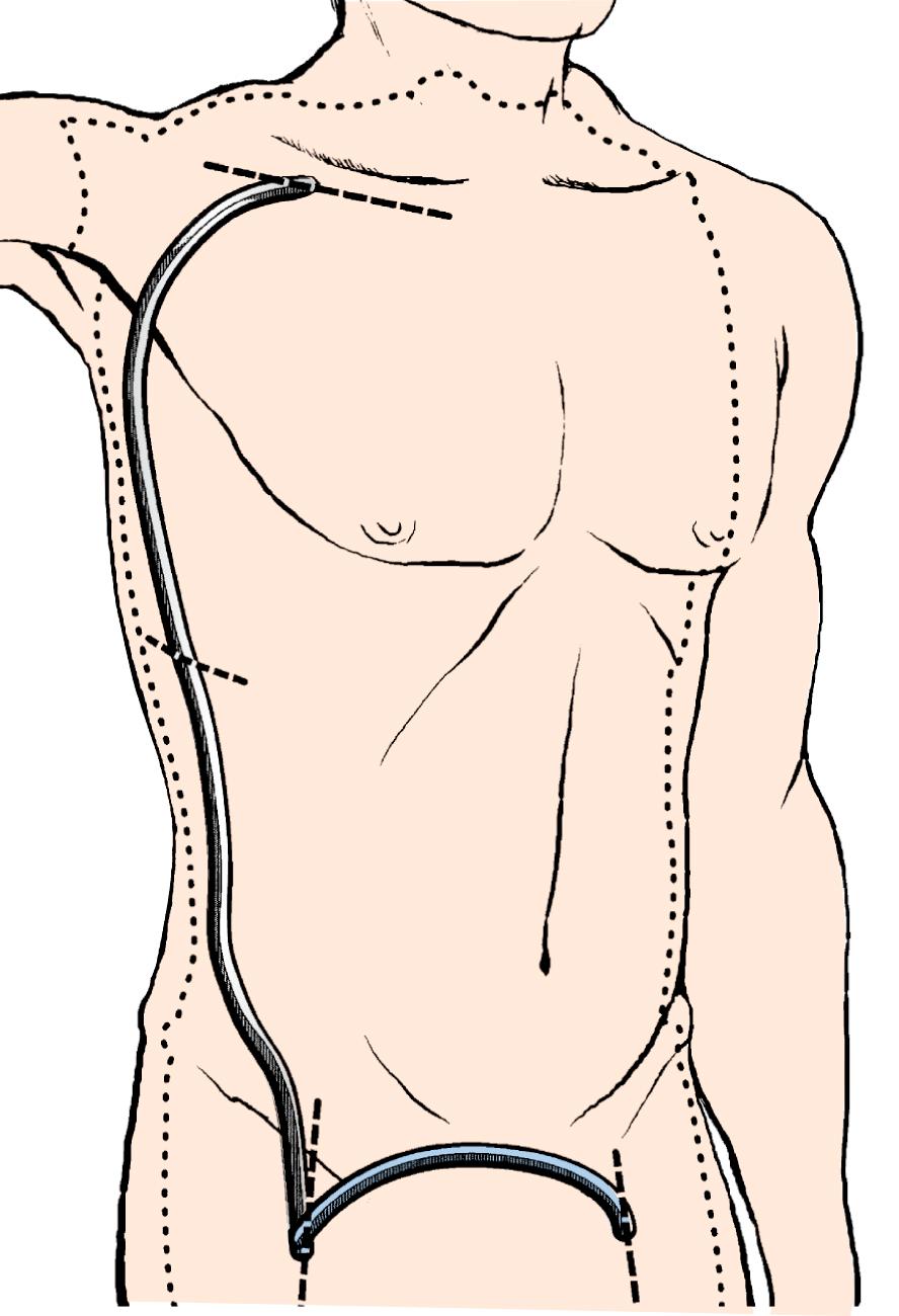 Figure 110.2, Typical area of exposure for an axillobifemoral bypass graft. The right axillary artery is the donor artery in this case. The intermediate incision in the right lower chest or upper flank is generally unnecessary if an appropriate tunneler is used.