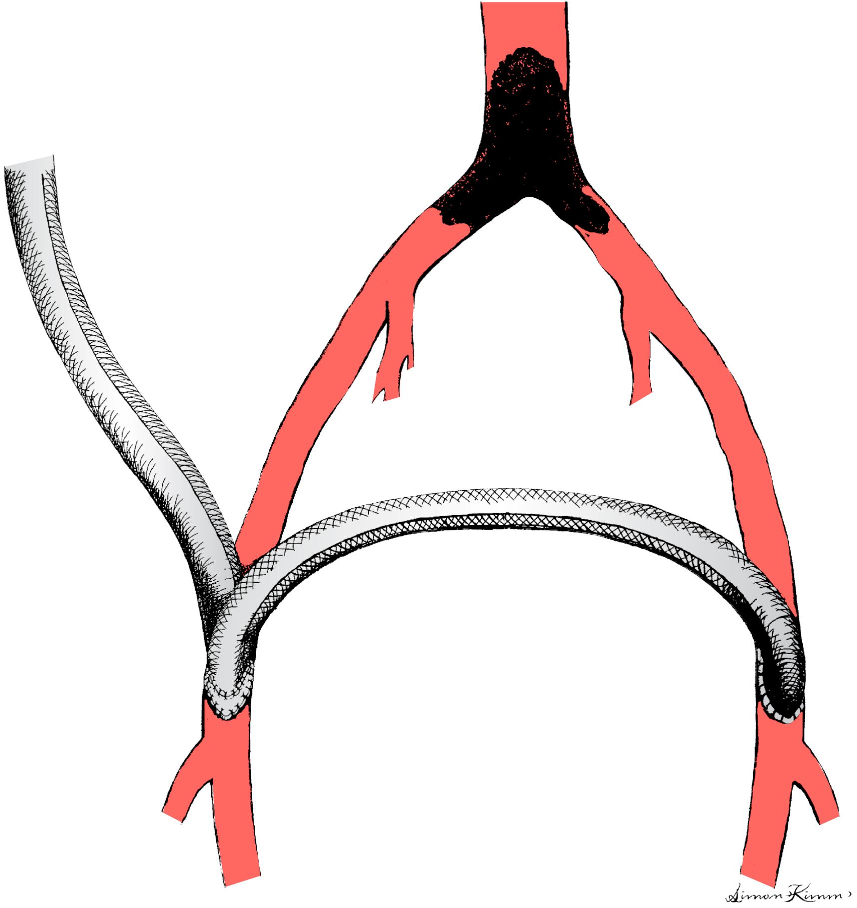 Figure 110.3, Typical configuration of an axillobifemoral bypass graft. In this case the right axillary artery is the “donor” and the axillofemoral component has been anastomosed to the native right common femoral artery, after which the right end of the femorofemoral component has been anastomosed to an ovoid graftotomy in the anterior wall of the anastomotic hood of the axillofemoral component.