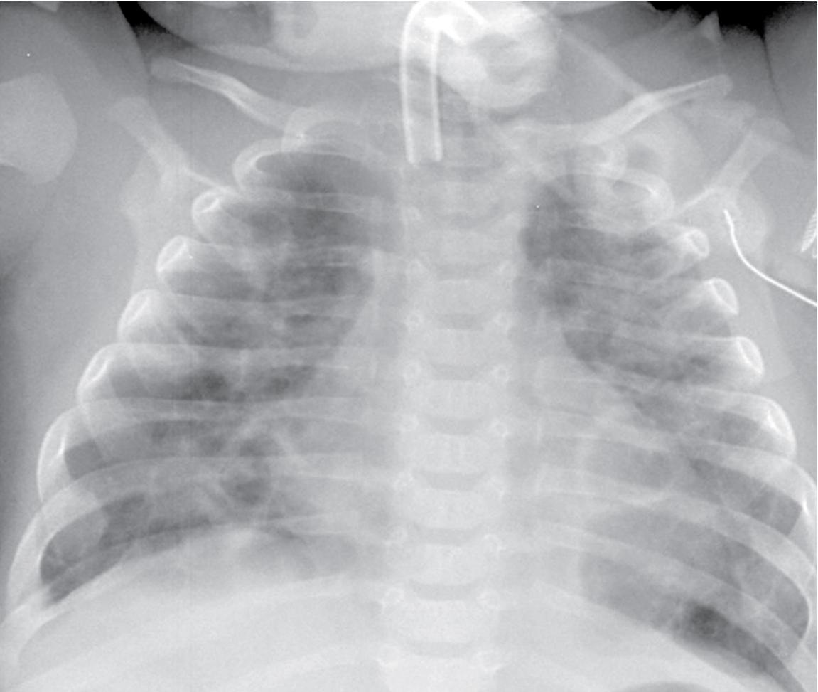 Fig. 14.1, Chest x-ray showing advanced findings of severe, ventilator-dependent BPD. BPD , Bronchopulmonary dysplasia.