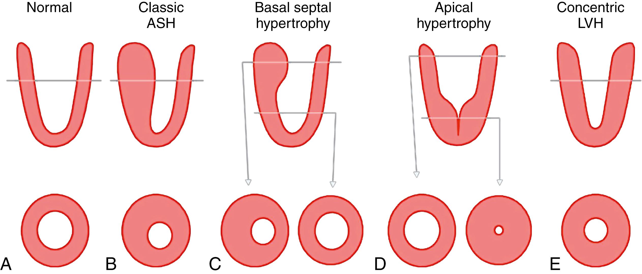 Figure 63.2, Diagram of the left ventricle in longitudinal (upper row) and short-axis, cross-sectional view (lower row) illustrating the variable distribution of hypertrophy in a normal ventricle ( A ), three subtypes of hypertrophic cardiomyopathy ( B–D ), and concentric hypertrophy ( E ). C and D, The distribution at basal and apical levels. Note the similarity of this diagram to the magnetic resonance imaging of a patient in Fig. 63.3. ASH, Asymmetric septal hypertrophy; LVH, left ventricular hypertrophy.