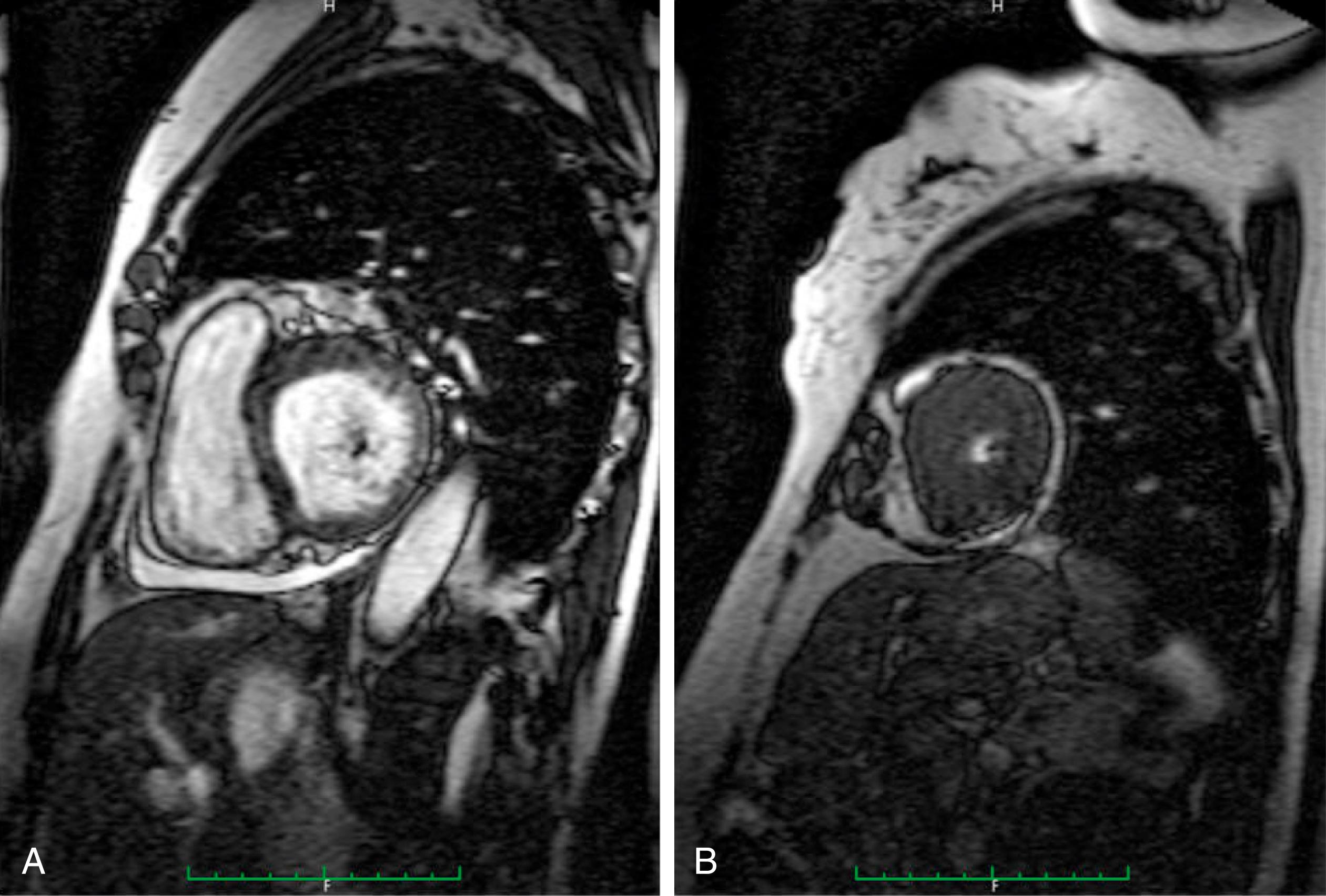 Figure 63.3, Cross-sectional views of the left ventricle by magnetic resonance imaging in a different patient illustrating the normal thickness and cavity size at the base ( A ) and the marked thickness and tiny cavity at the apex ( B ).