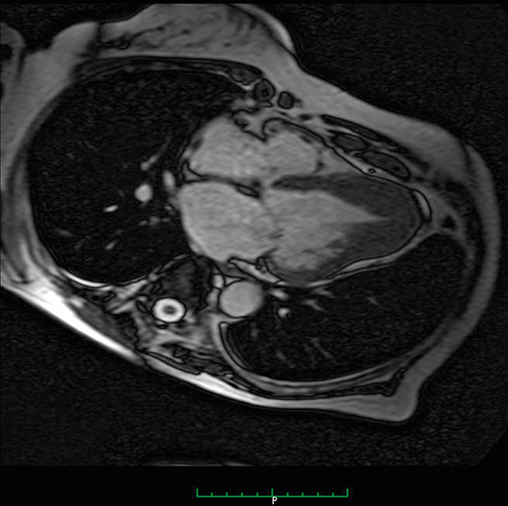 Figure 63.4, Magnetic resonance imaging (horizontal plane) illustrates the characteristic spade-like appearance of this patient (same as in Fig. 63.3) with apical hypertrophic cardiomyopathy.